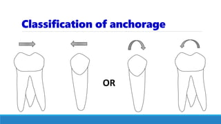 Classification of anchorage
OR
 