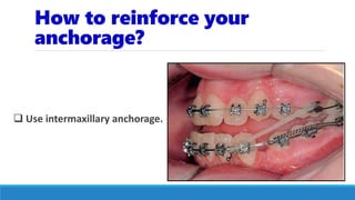 How to reinforce your
anchorage?
 Use intermaxillary anchorage.
 