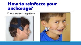 How to reinforce your
anchorage?
 Use extraoral appliance.
 