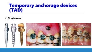 Temporary anchorage devices
(TAD)
a. Miniscrew
 