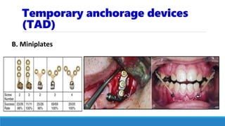 Temporary anchorage devices
(TAD)
B. Miniplates
 