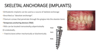 SKELETAL ANCHORAGE (IMPLANTS)
•Orthodontic implants can be used as a source of skeletal anchorage
•Described as “absolute anchorage”.
•Titanium screws that penetrate through the gingiva into the alveolar bone
•Temporary anchoring devices (TAD)
•TADs can be located transosteally,subperiosteally
Or endosteally .
• Fixed to bone either mechanically or biochemically
 