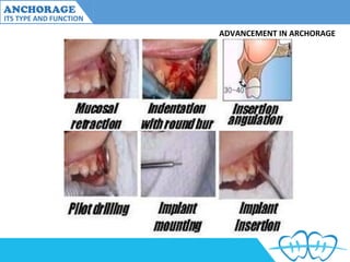Anchorage and its type and variations | PPT