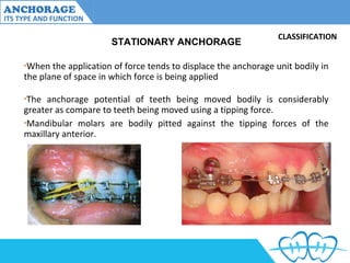 Anchorage and its type and variations | PPT