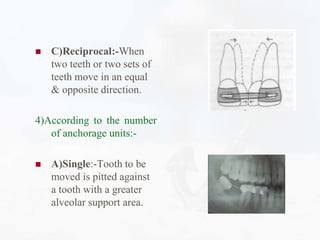 Reciprocal Tooth anchorage .pptx