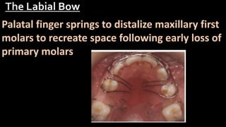 Anchorage for removable orthodontic appliances | PPTX