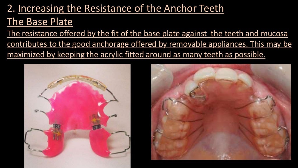Anchorage for removable orthodontic appliances