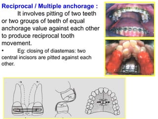 Reciprocal Tooth Anchorage in orthodontics | PPT