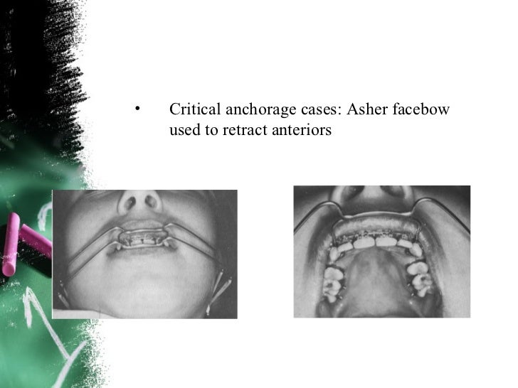 Anchorage in orthodontics