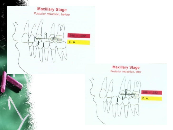 Anchorage in orthodontics