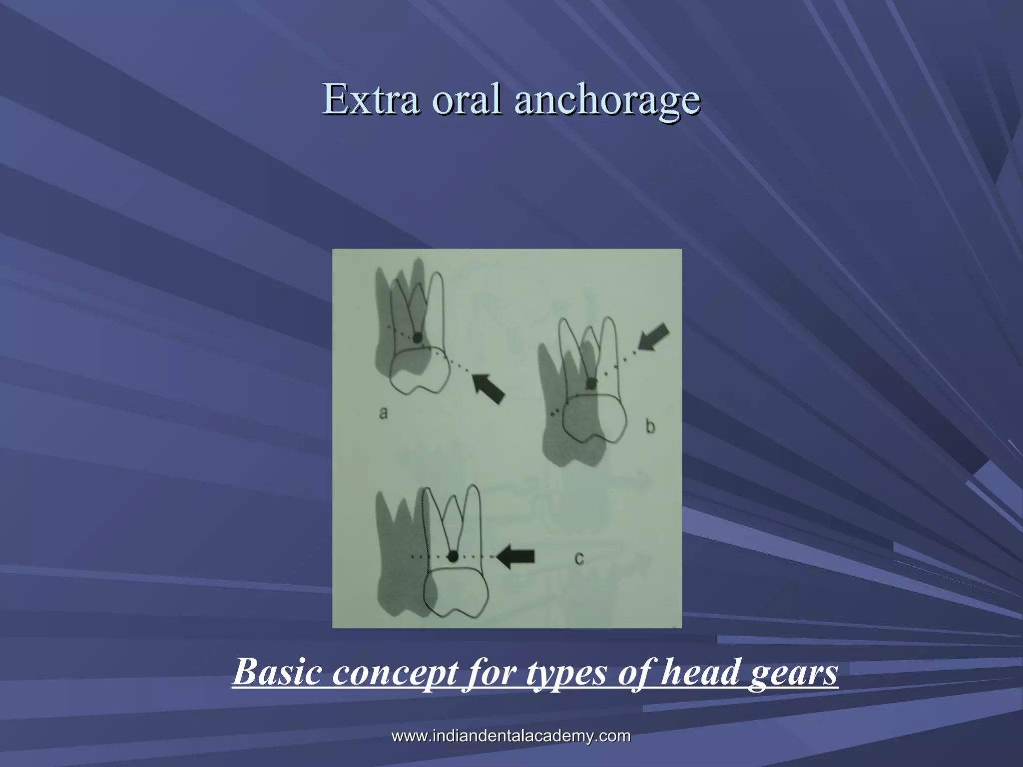 Extra oral anchorage

Basic concept for types of head gears
www.indiandentalacademy.com

 