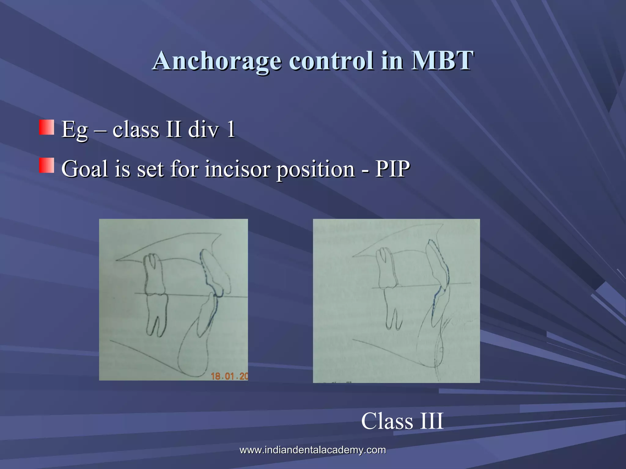 Anchorage control in MBT
Eg – class II div 1
Goal is set for incisor position - PIP

Class III
www.indiandentalacademy.com

 