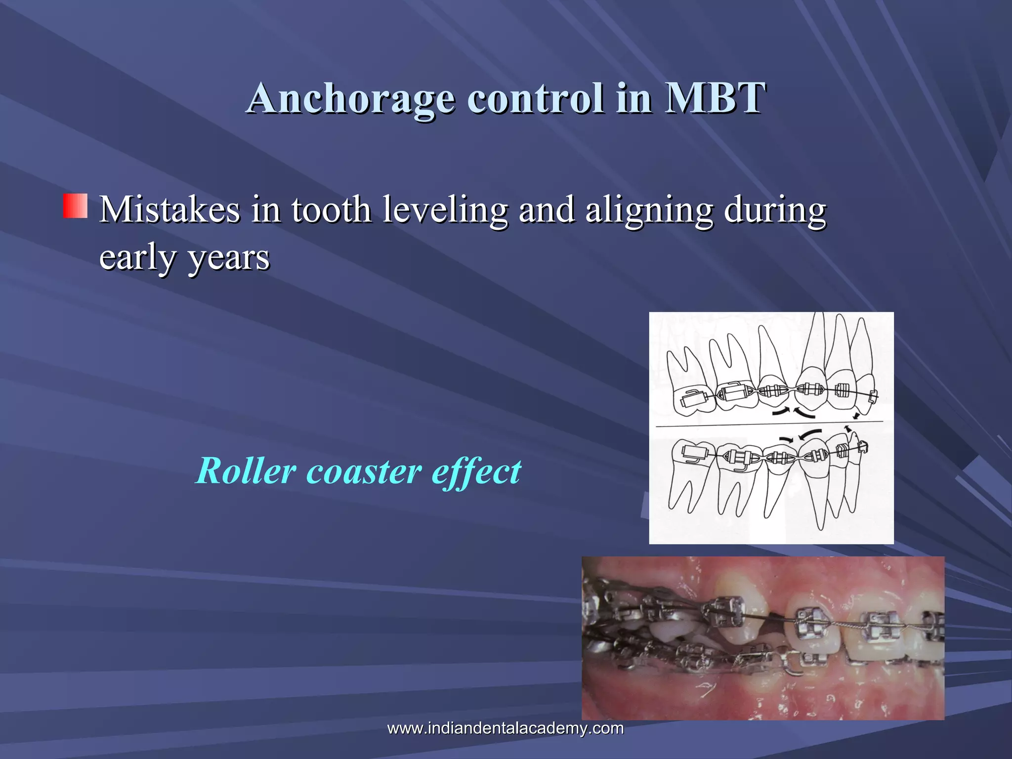 Anchorage control in MBT
Mistakes in tooth leveling and aligning during
early years

Roller coaster effect

www.indiandentalacademy.com

 