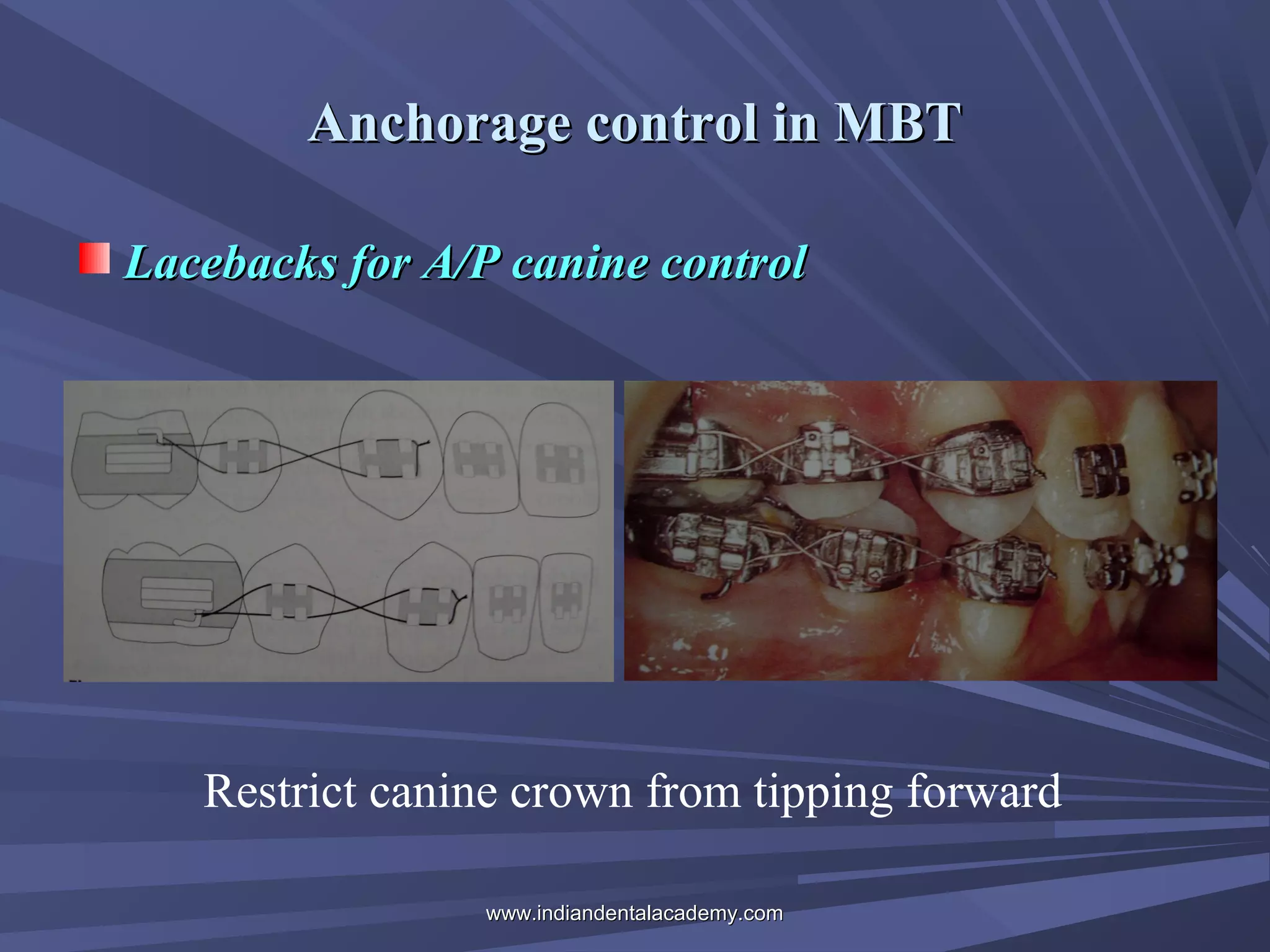 Anchorage control in MBT
Lacebacks for A/P canine control

Restrict canine crown from tipping forward
www.indiandentalacademy.com

 
