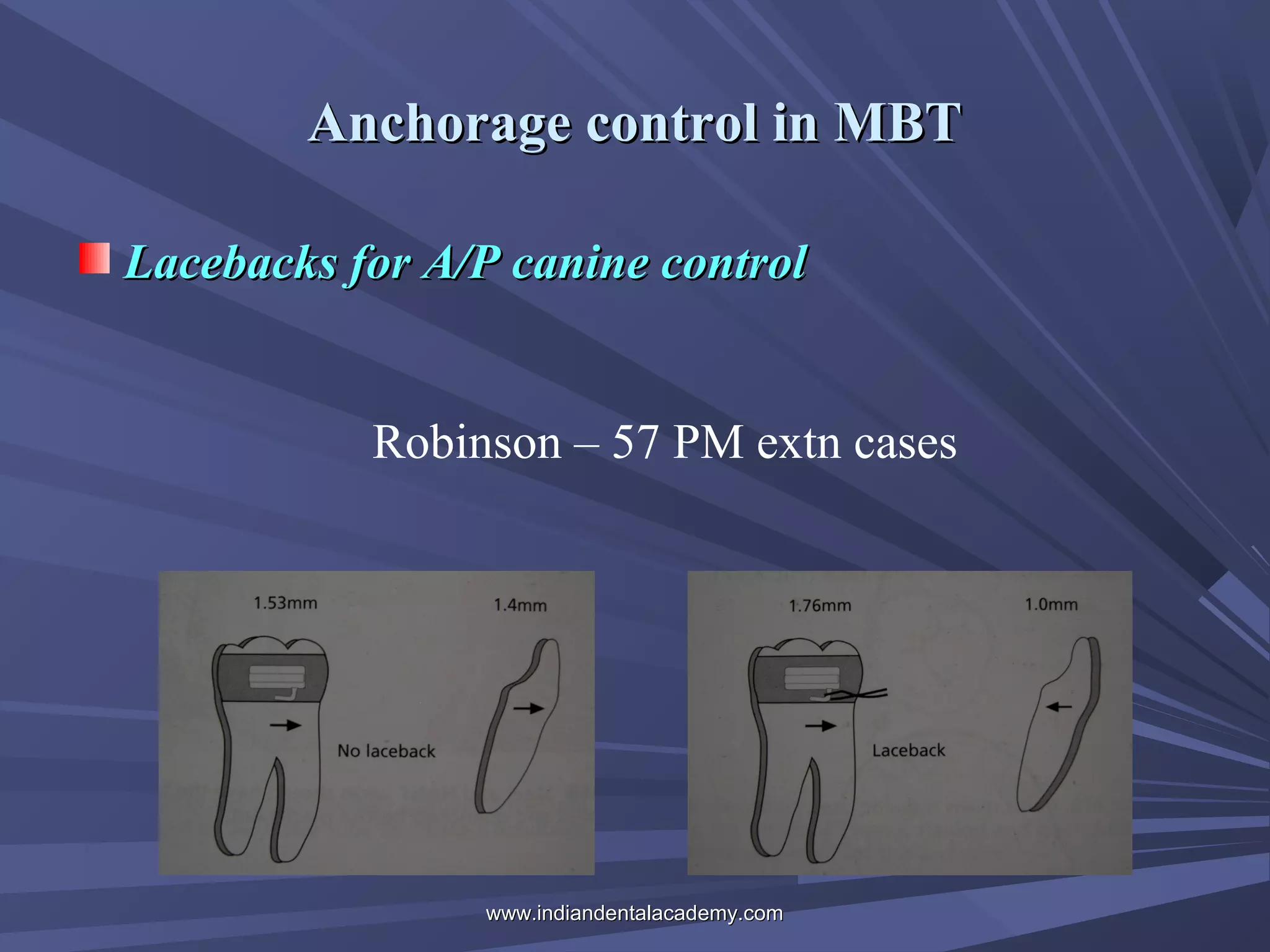 Anchorage control in MBT
Lacebacks for A/P canine control
Robinson – 57 PM extn cases

www.indiandentalacademy.com

 