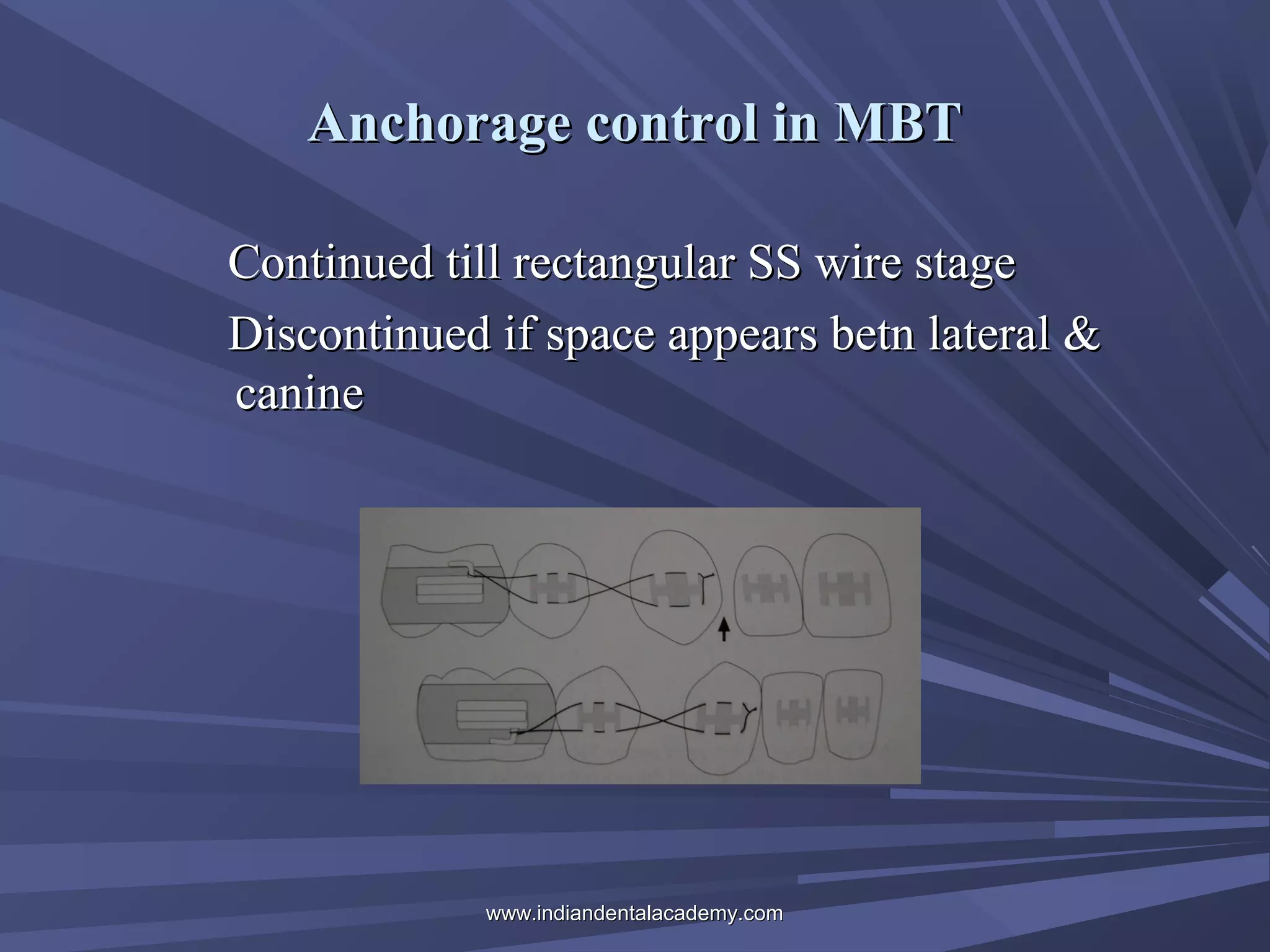 Anchorage control in MBT
Continued till rectangular SS wire stage
Discontinued if space appears betn lateral &
canine

www.indiandentalacademy.com

 