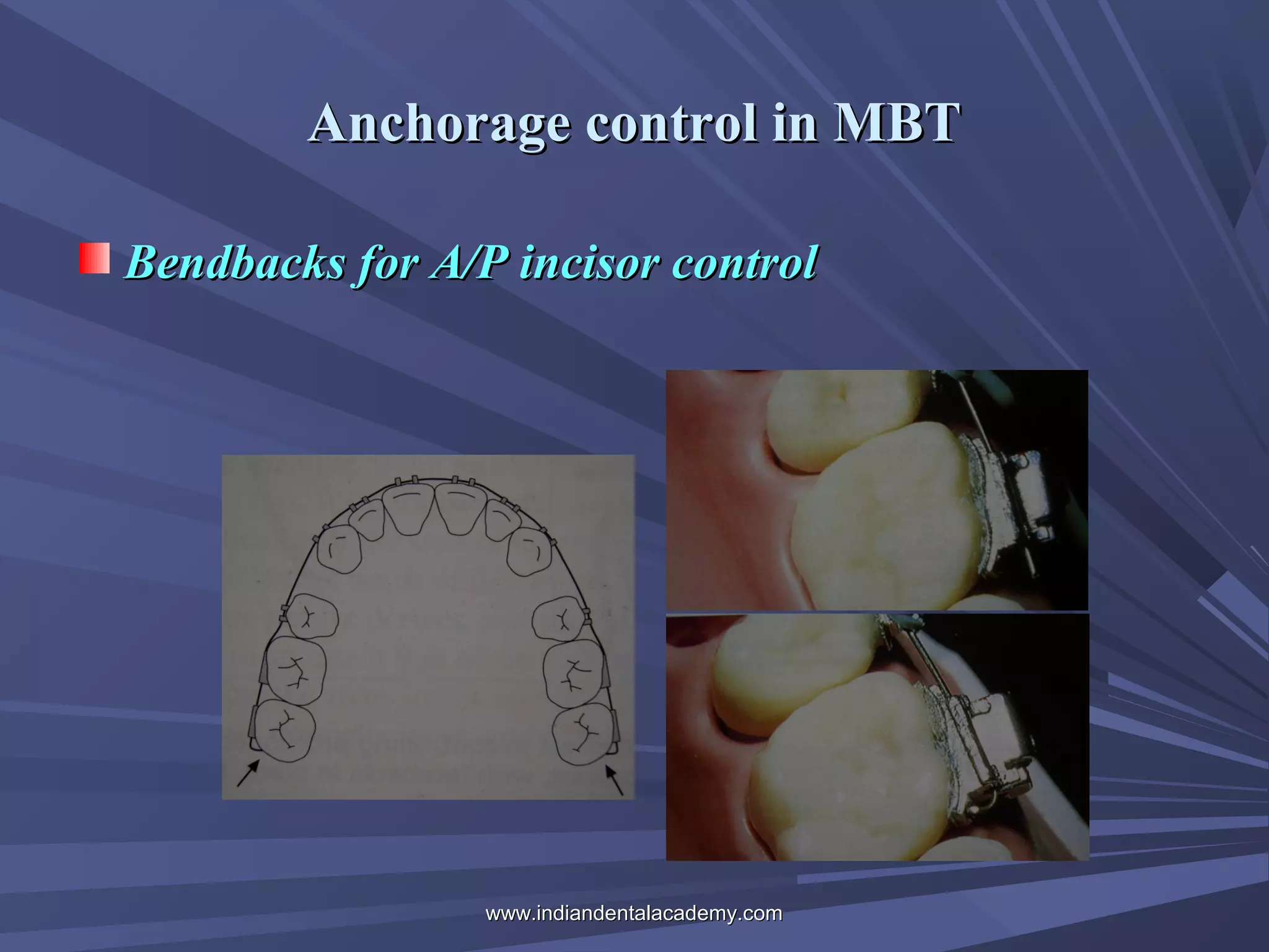 Anchorage control in MBT
Bendbacks for A/P incisor control

www.indiandentalacademy.com

 