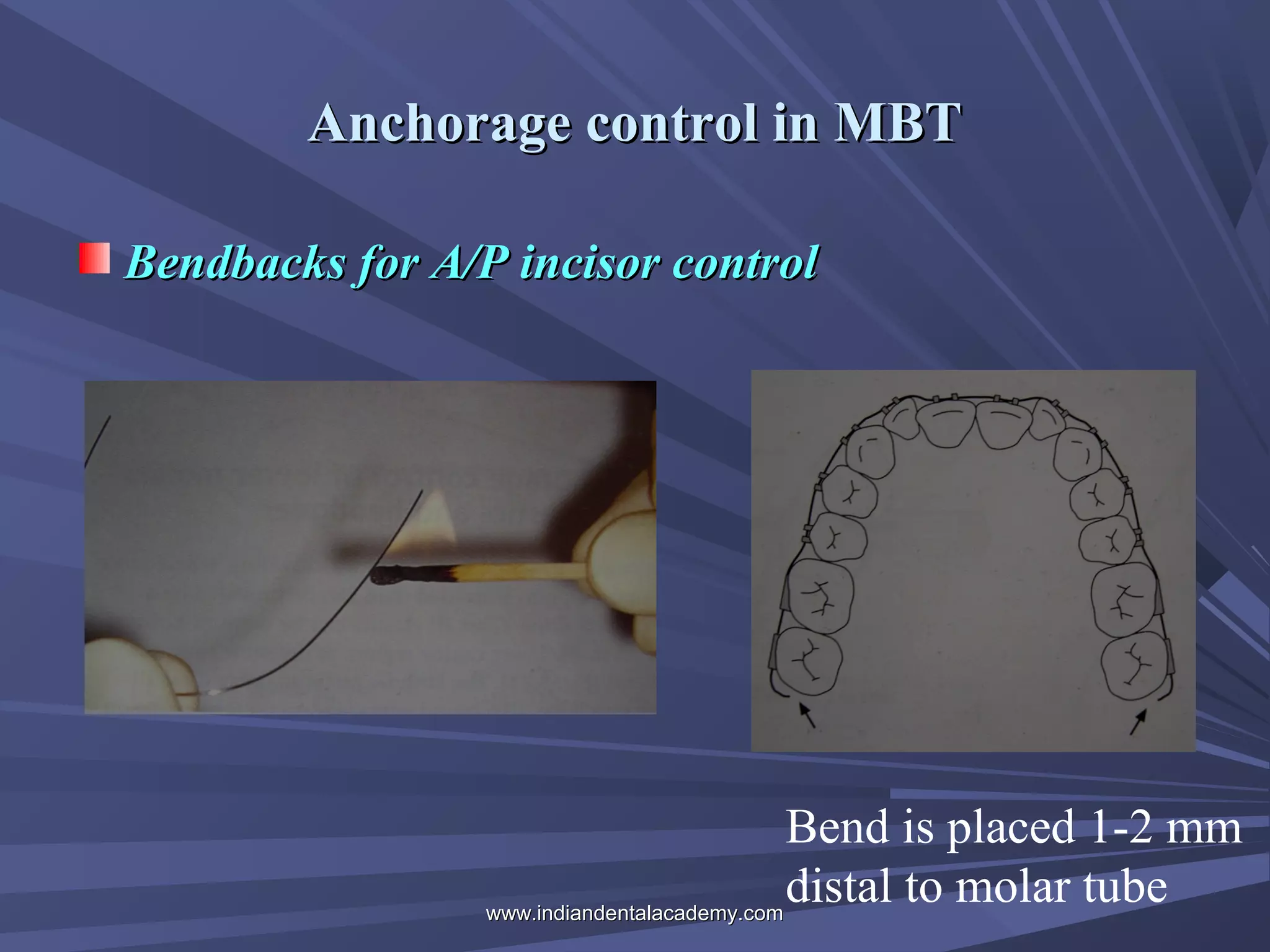 Anchorage control in MBT
Bendbacks for A/P incisor control

Bend is placed 1-2 mm
distal to molar tube
www.indiandentalacademy.com

 
