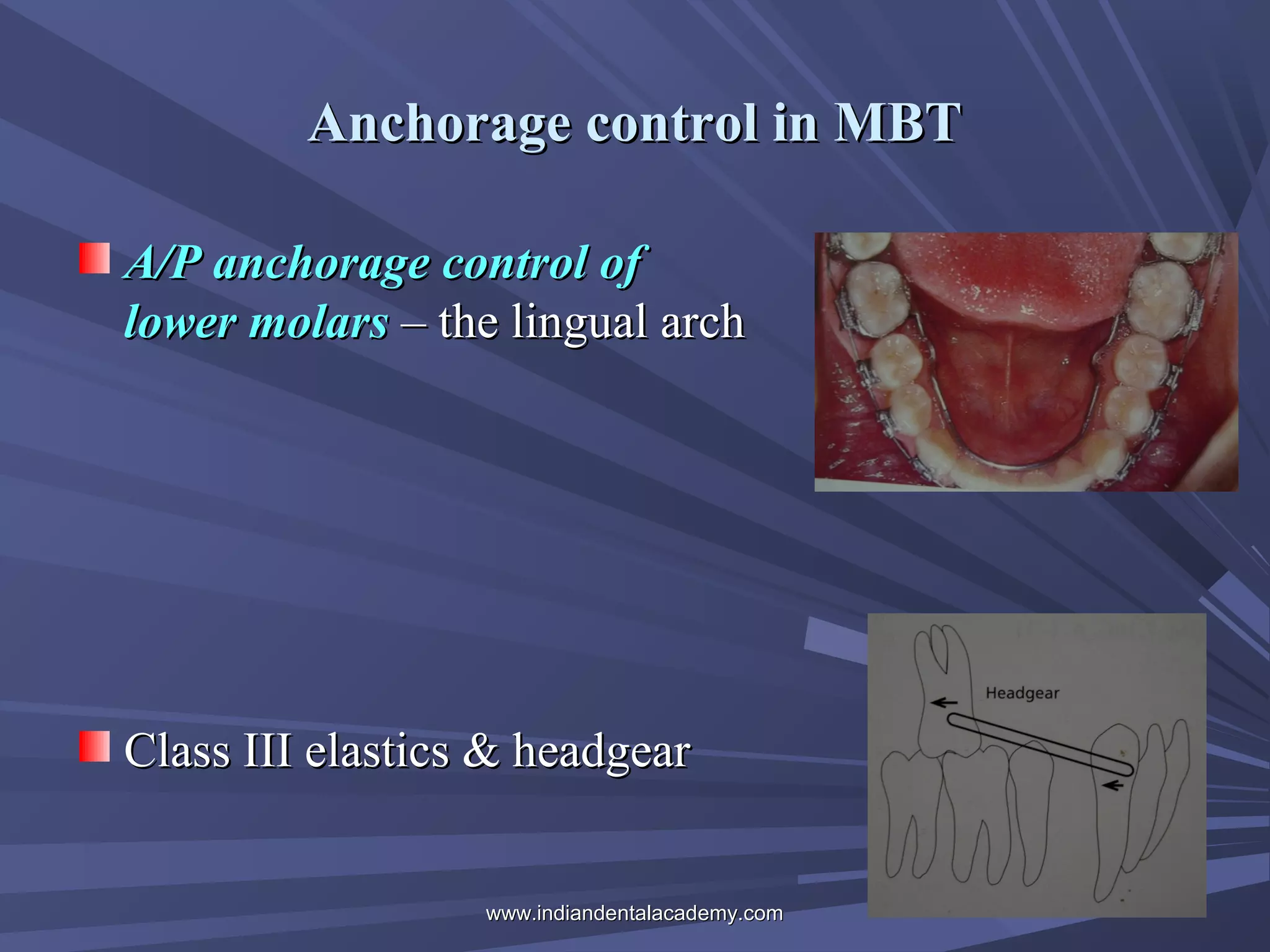 Anchorage control in MBT
A/P anchorage control of
lower molars – the lingual arch

Class III elastics & headgear
www.indiandentalacademy.com

 