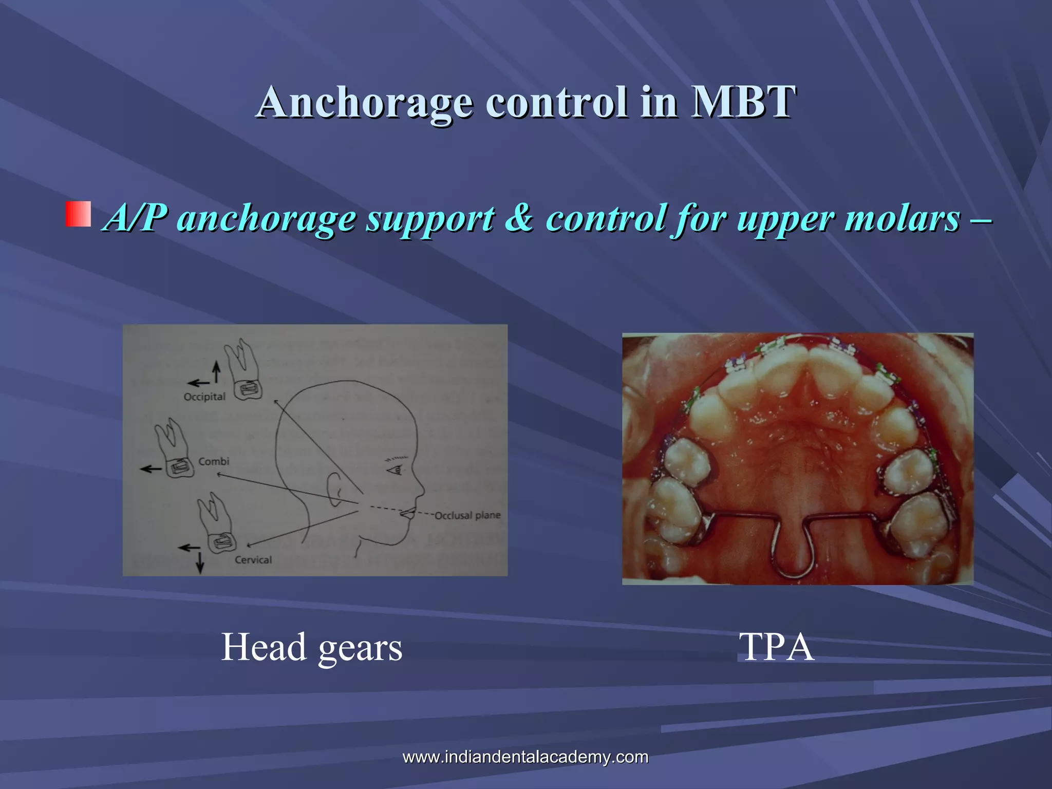 Anchorage control in MBT
A/P anchorage support & control for upper molars –

Head gears
www.indiandentalacademy.com

TPA

 