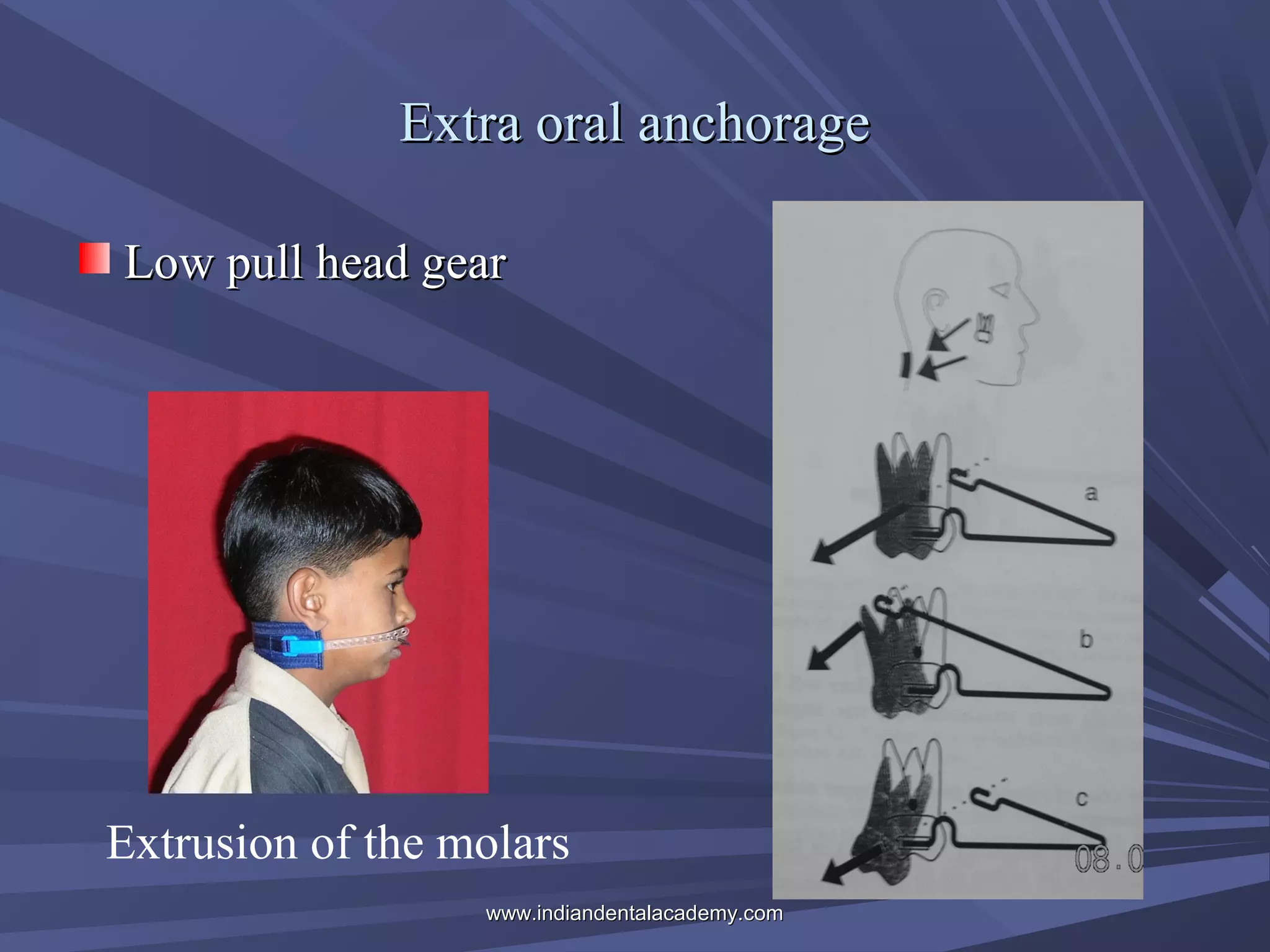 Extra oral anchorage
Low pull head gear

Extrusion of the molars
www.indiandentalacademy.com

 