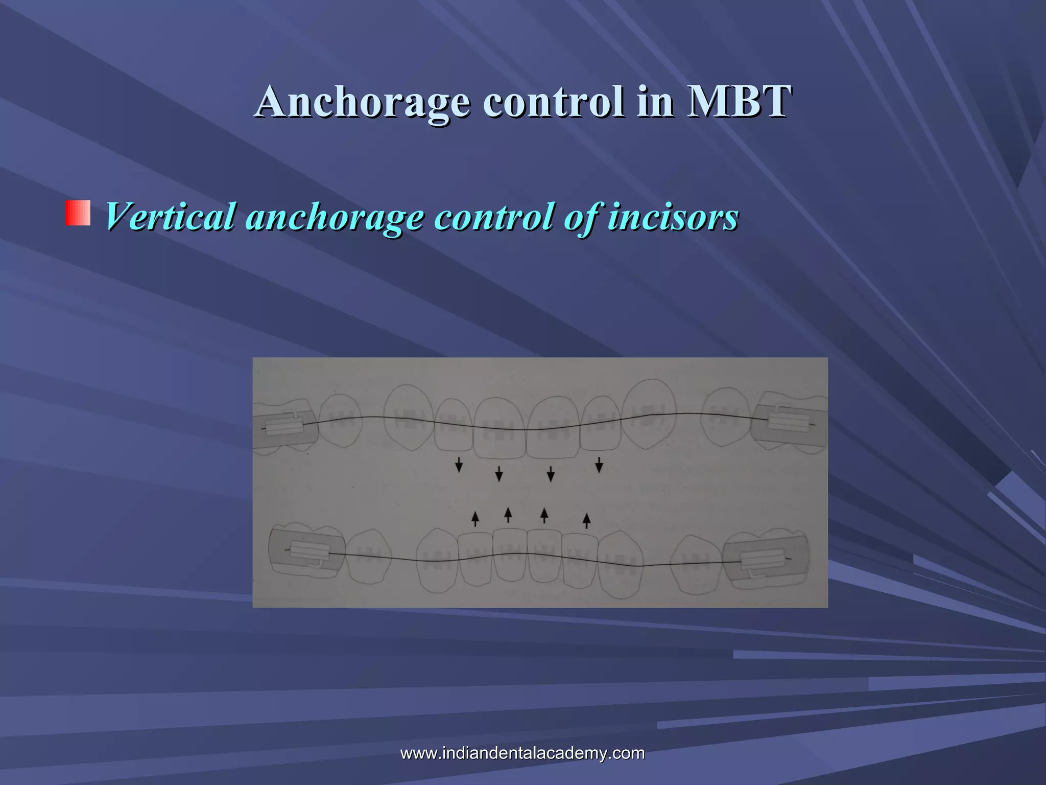 Anchorage control in MBT
Vertical anchorage control of incisors

www.indiandentalacademy.com

 