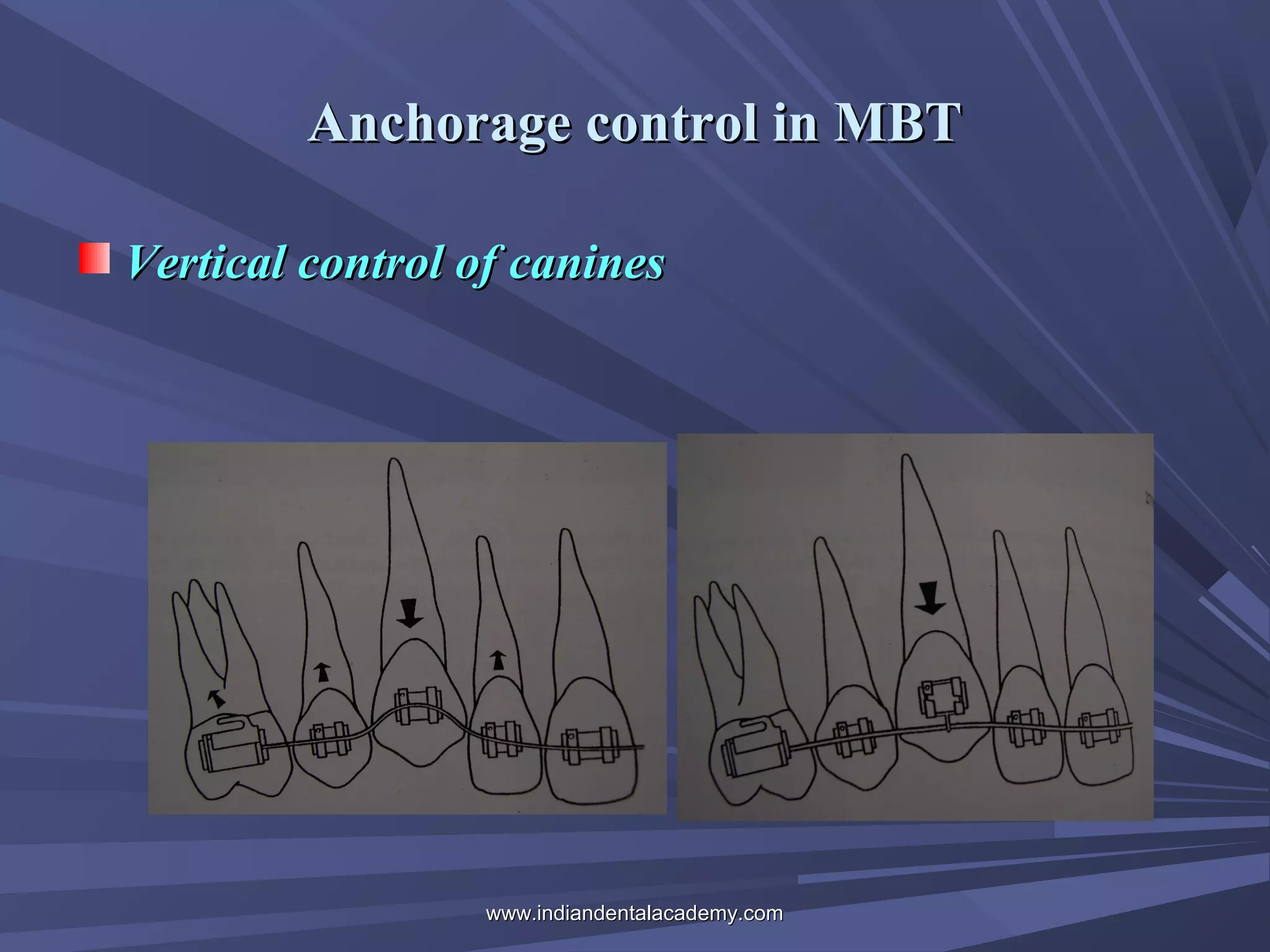 Anchorage control in MBT
Vertical control of canines

www.indiandentalacademy.com

 
