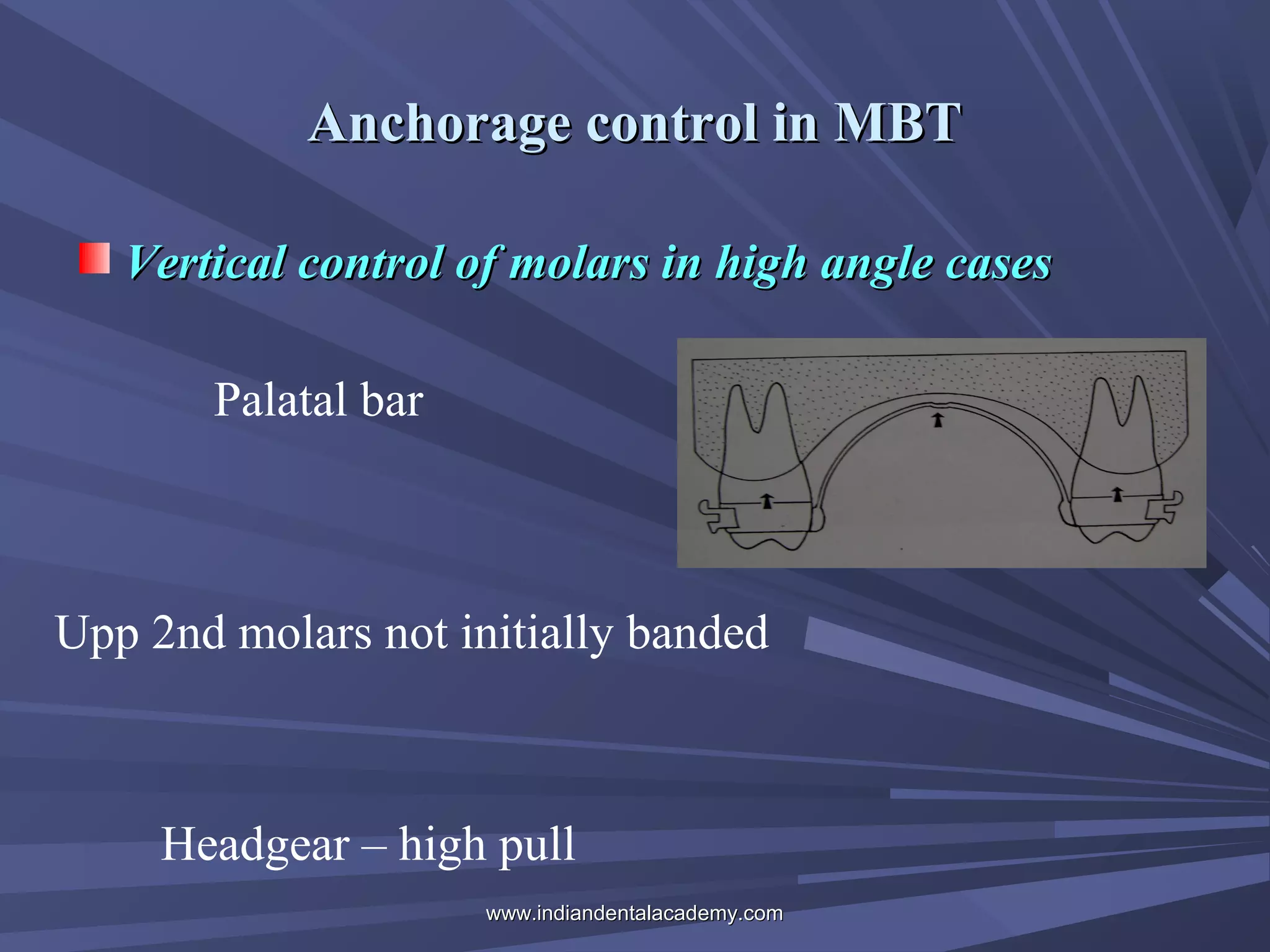 Anchorage control in MBT
Vertical control of molars in high angle cases
Palatal bar

Upp 2nd molars not initially banded

Headgear – high pull
www.indiandentalacademy.com

 