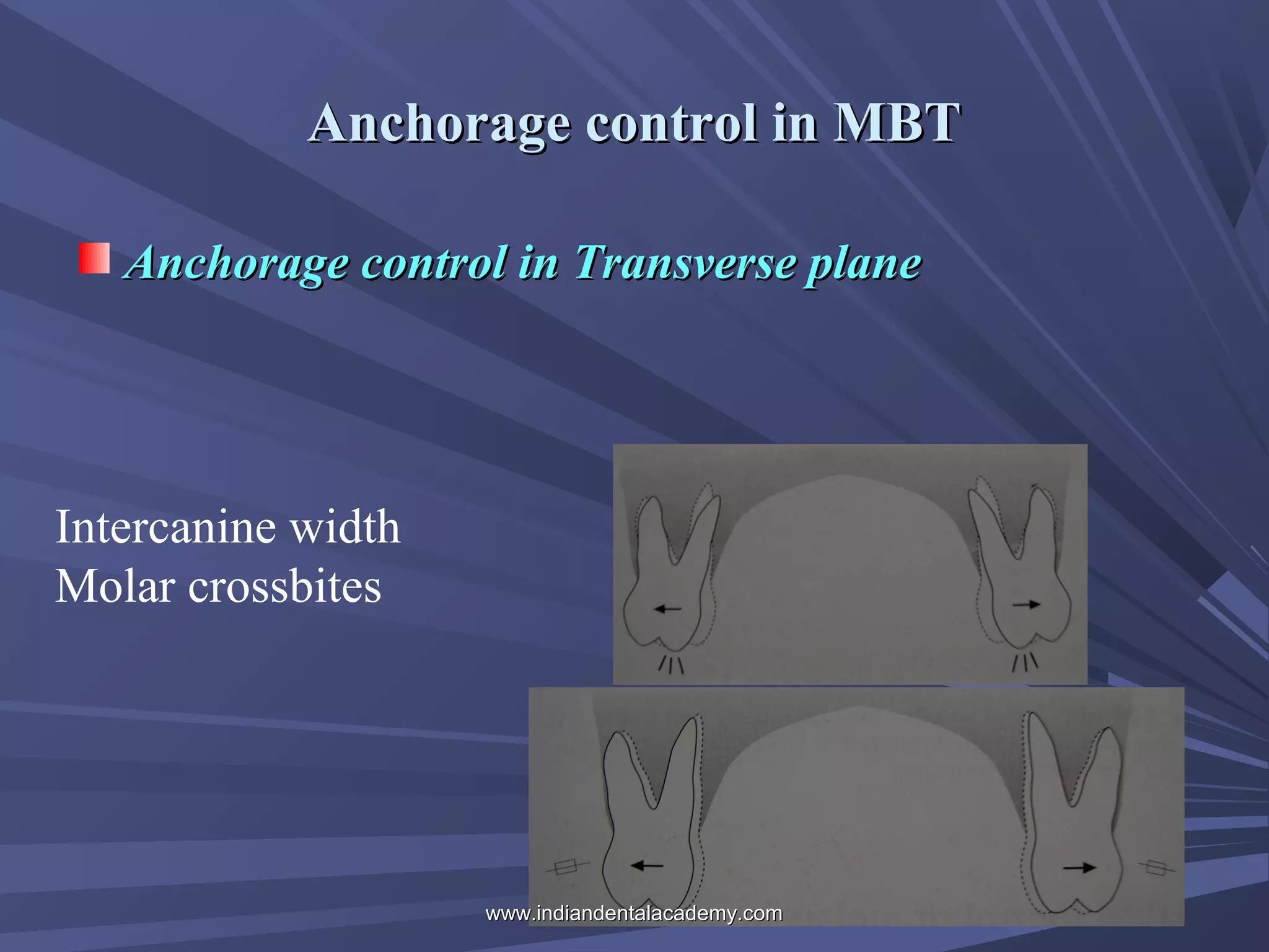 Anchorage control in MBT
Anchorage control in Transverse plane

Intercanine width
Molar crossbites

www.indiandentalacademy.com

 