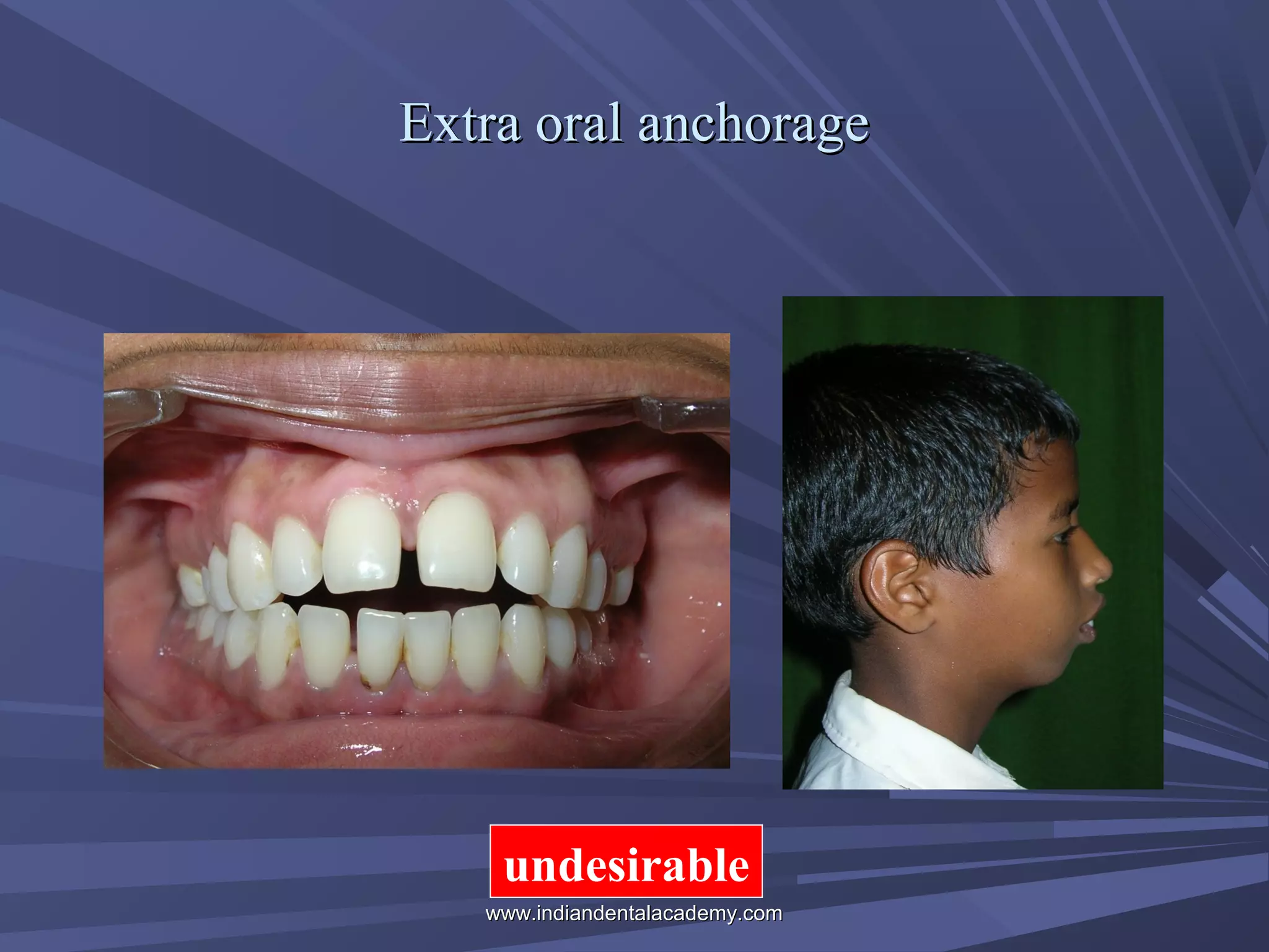 Extra oral anchorage

undesirable
www.indiandentalacademy.com

 
