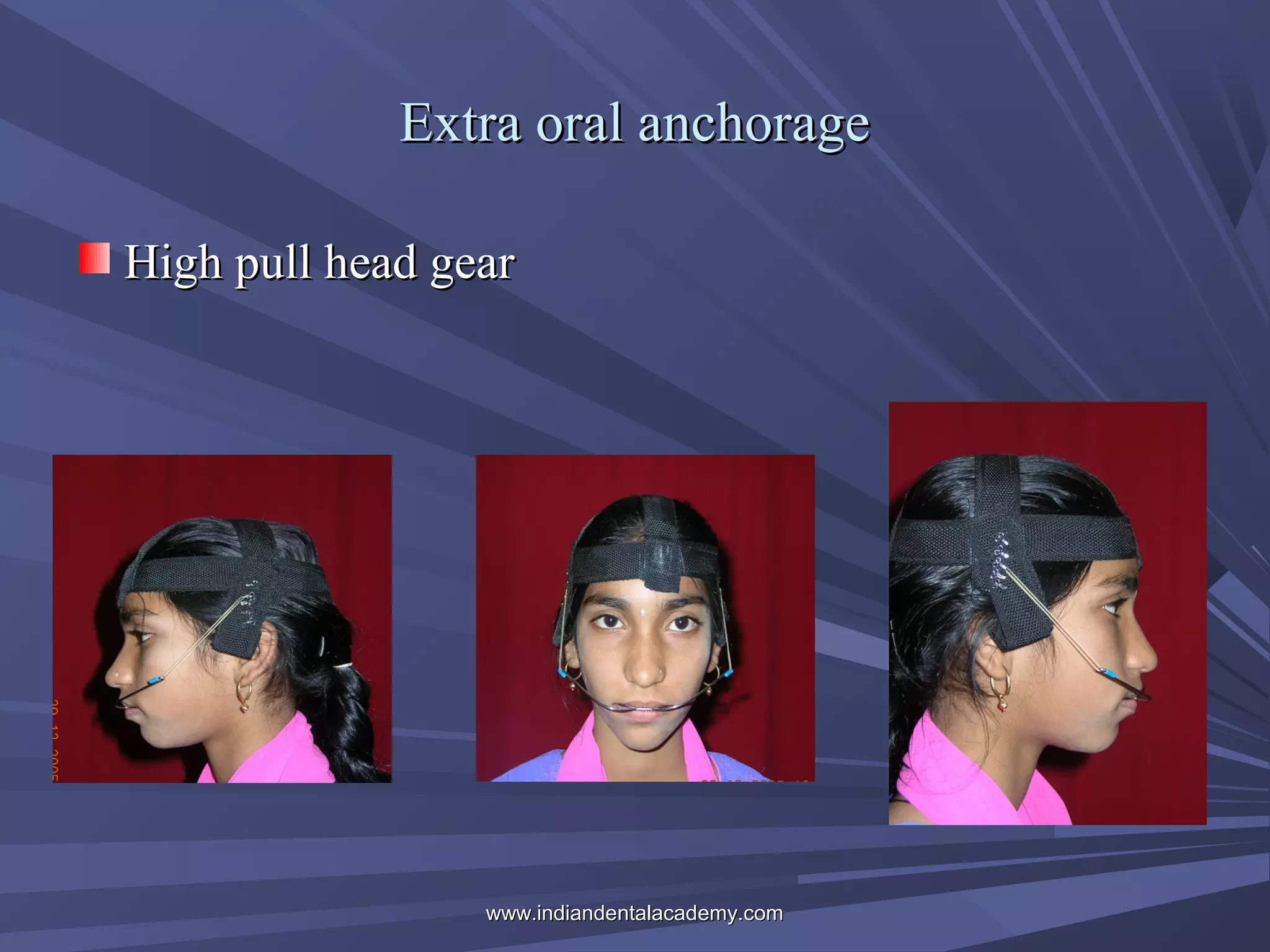 Extra oral anchorage
High pull head gear

www.indiandentalacademy.com

 