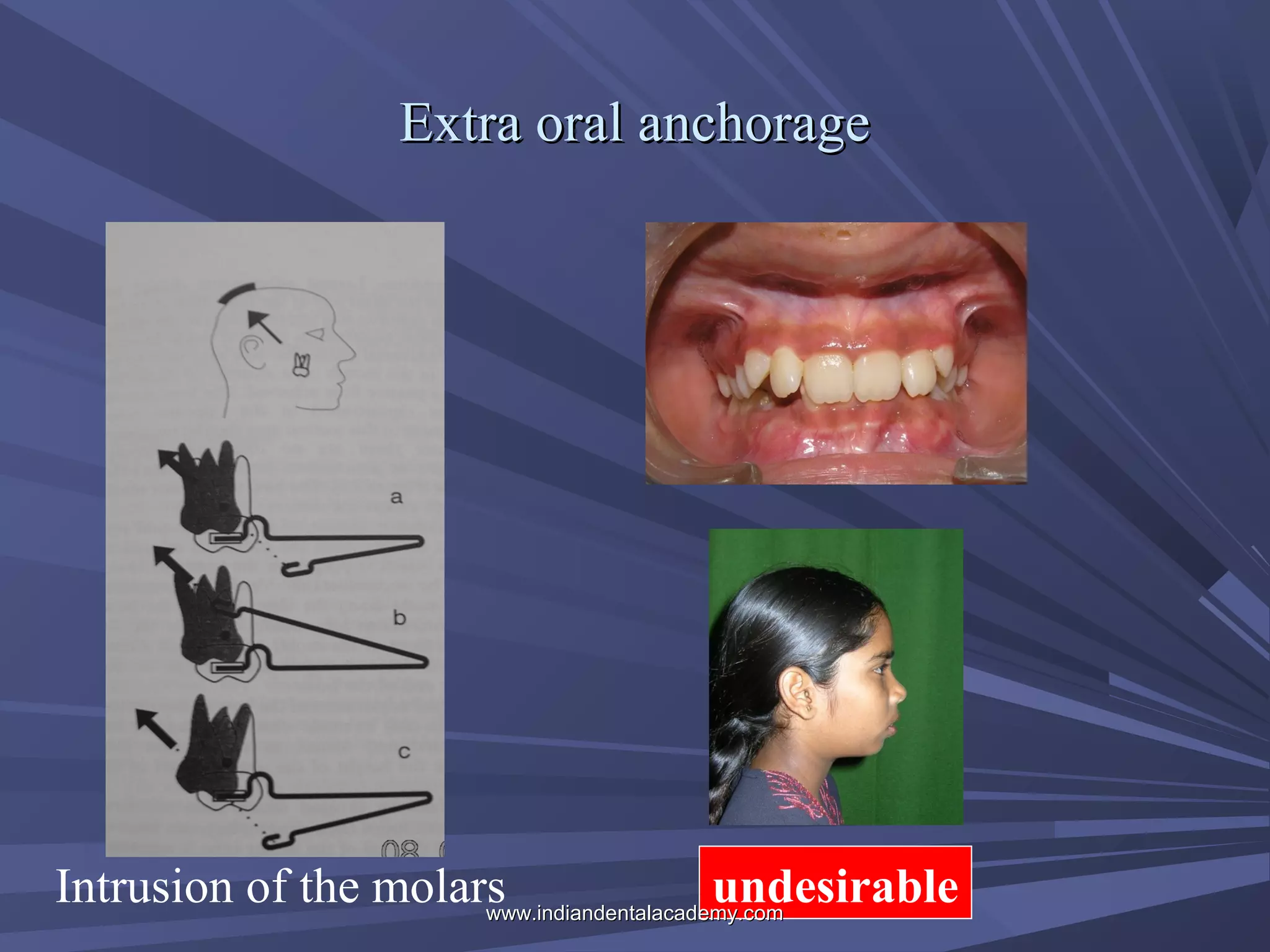 Extra oral anchorage

Intrusion of the molars
undesirable
www.indiandentalacademy.com

 