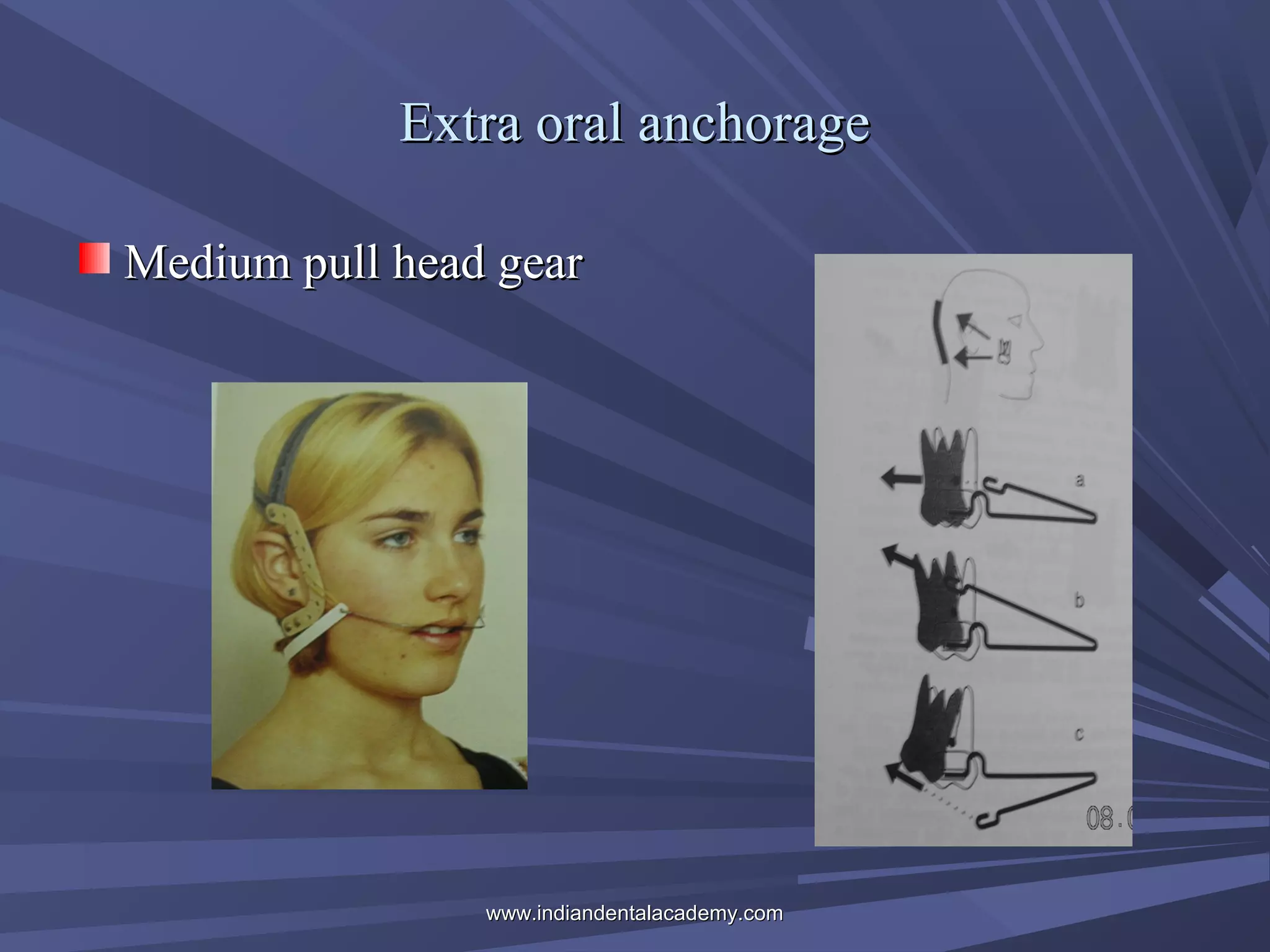 Extra oral anchorage
Medium pull head gear

www.indiandentalacademy.com

 