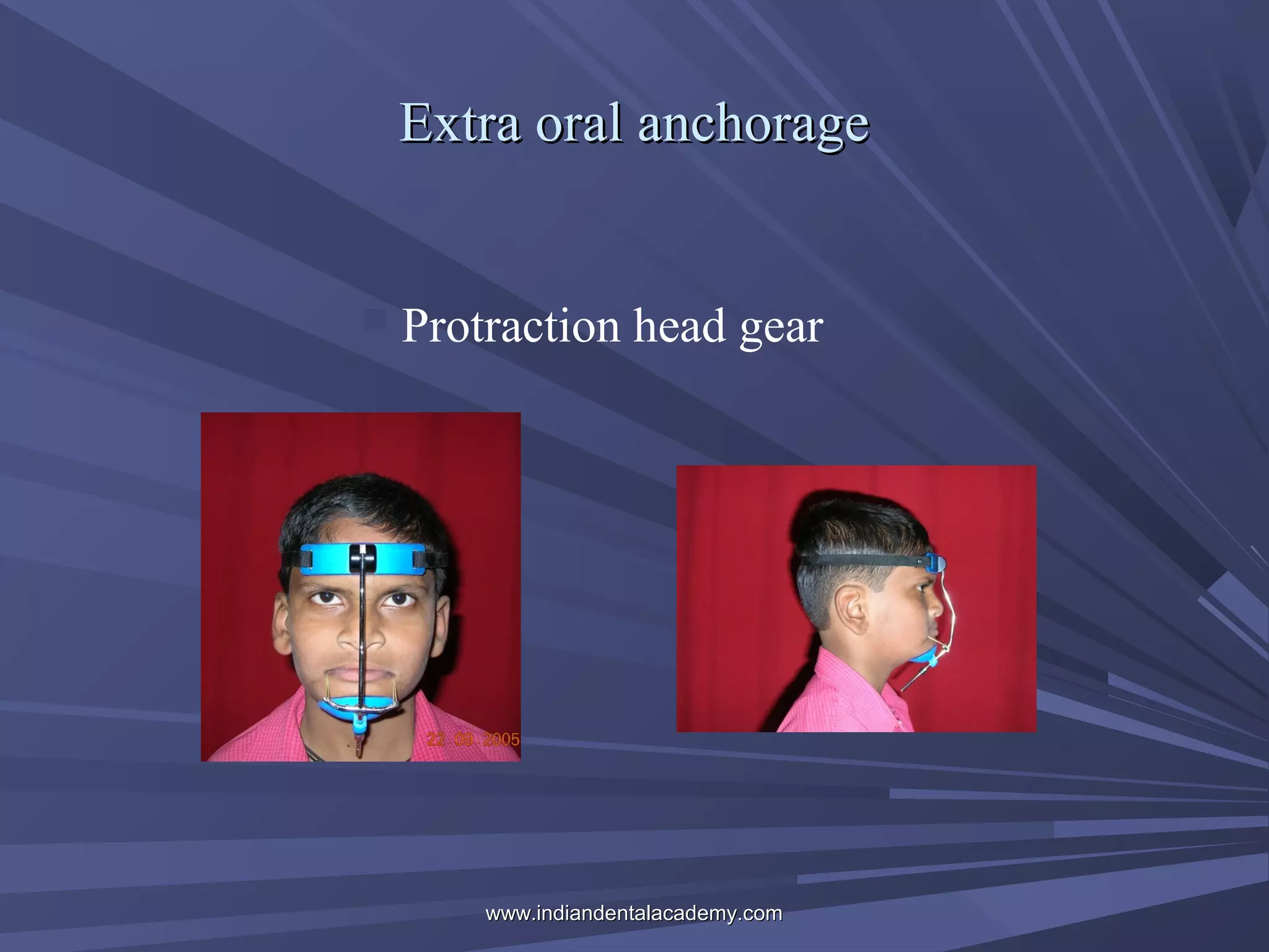 Extra oral anchorage



Protraction head gear

www.indiandentalacademy.com

 