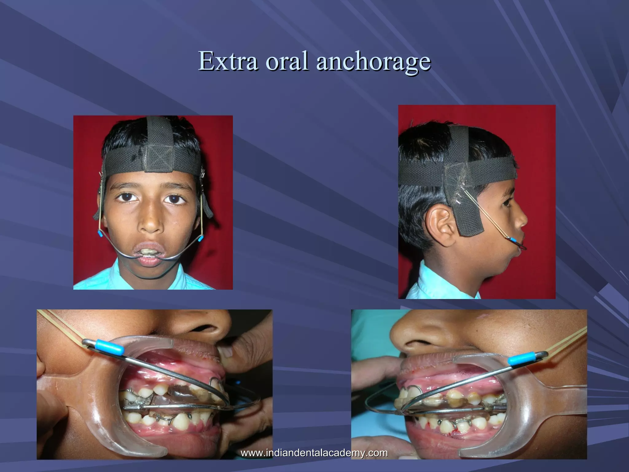Extra oral anchorage

www.indiandentalacademy.com

 