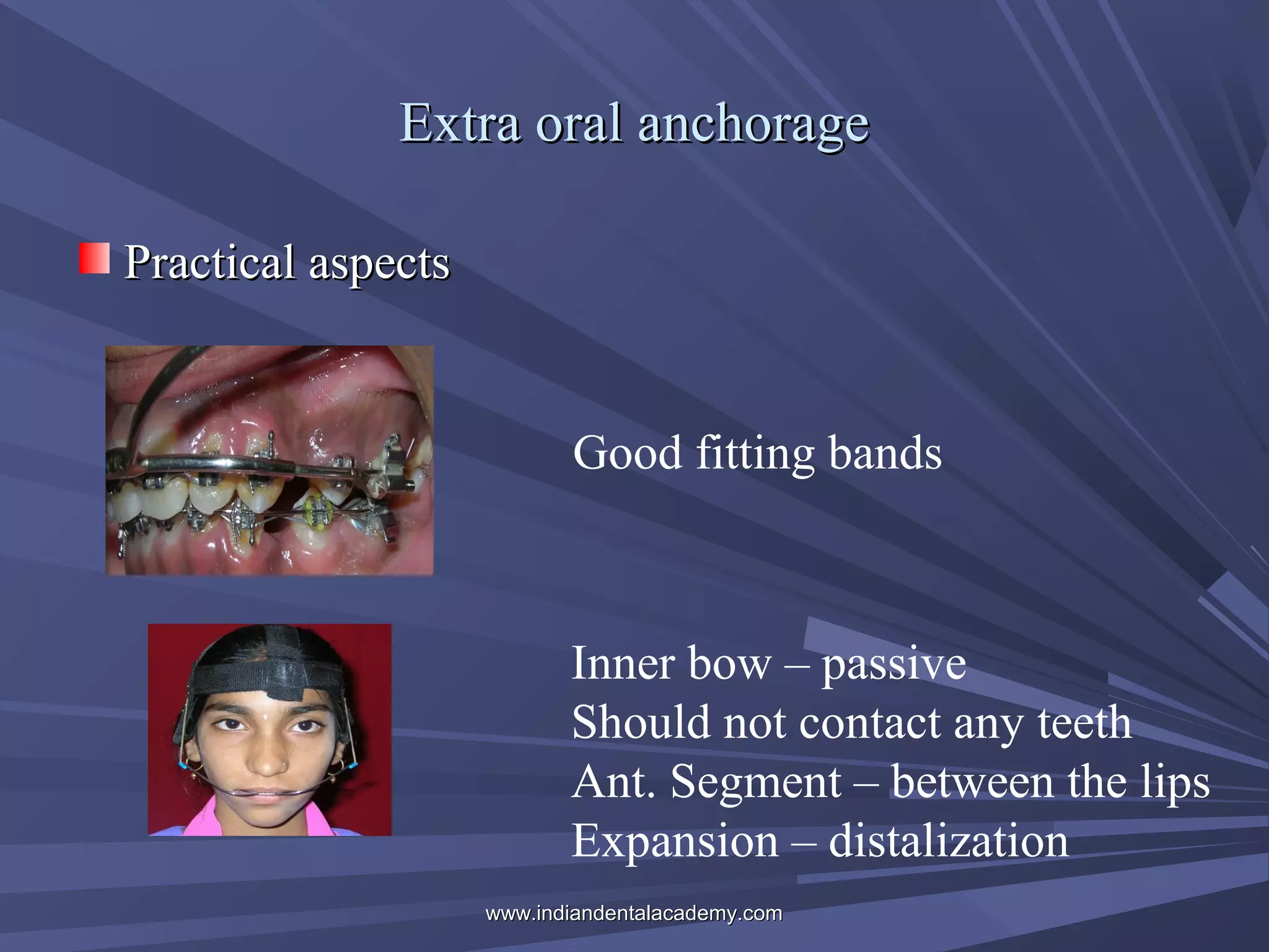 Extra oral anchorage
Practical aspects

Good fitting bands

Inner bow – passive
Should not contact any teeth
Ant. Segment – between the lips
Expansion – distalization
www.indiandentalacademy.com

 