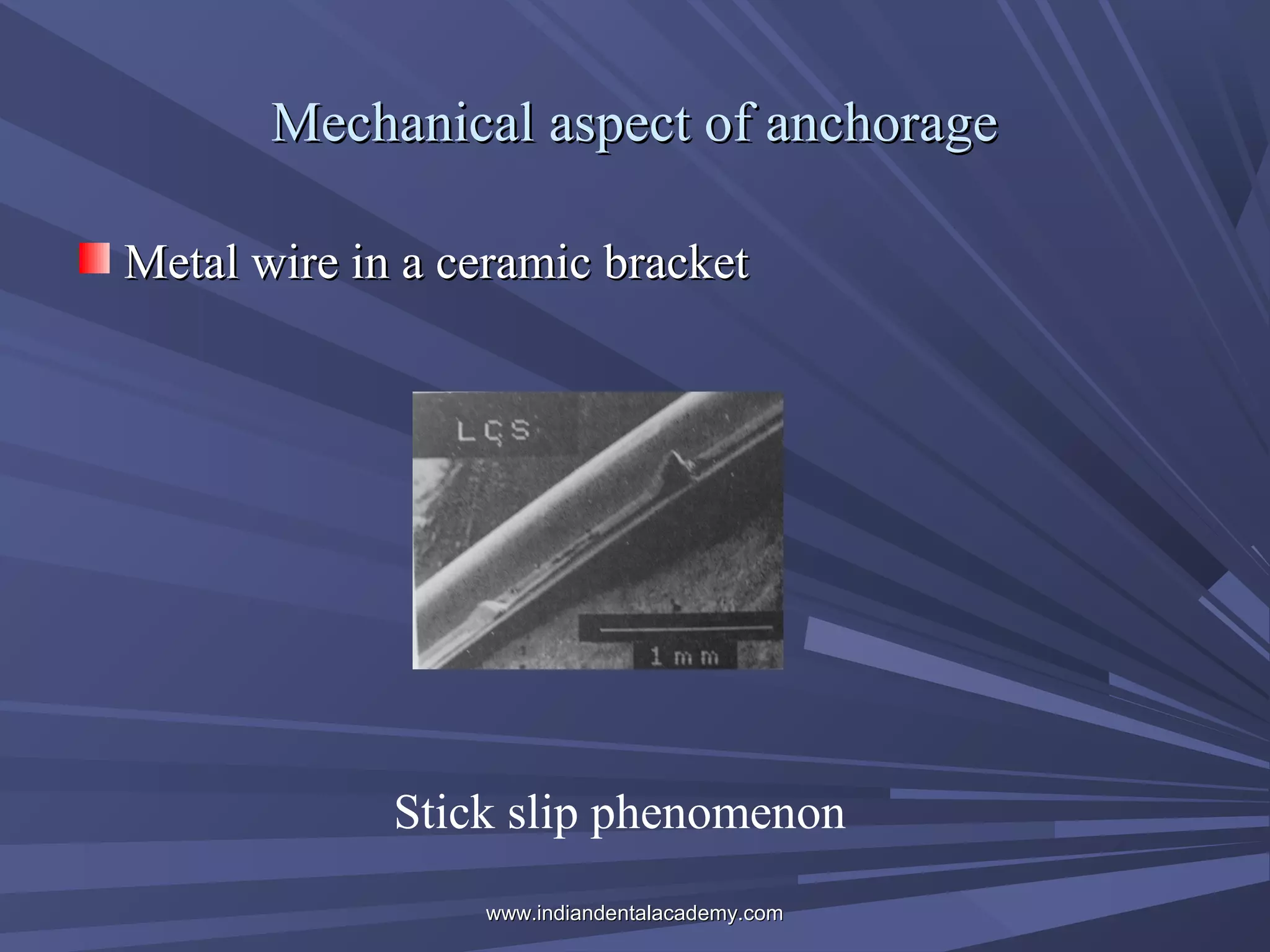 Mechanical aspect of anchorage
Metal wire in a ceramic bracket

Stick slip phenomenon
www.indiandentalacademy.com

 