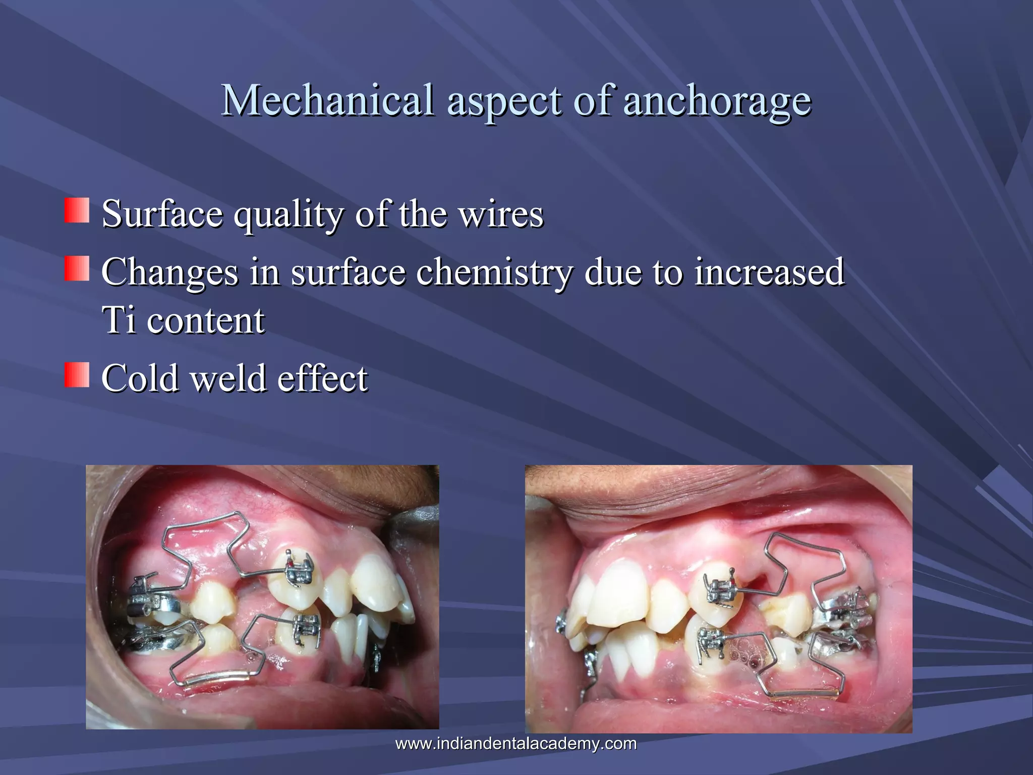Mechanical aspect of anchorage
Surface quality of the wires
Changes in surface chemistry due to increased
Ti content
Cold weld effect

www.indiandentalacademy.com

 