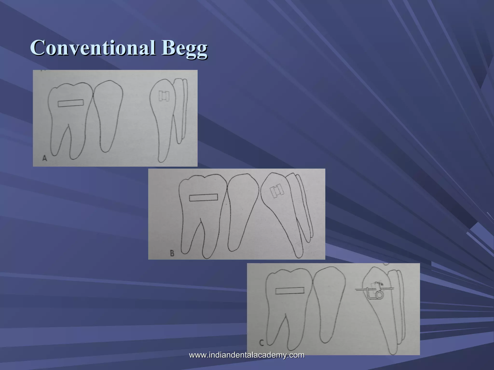 Conventional Begg

www.indiandentalacademy.com

 