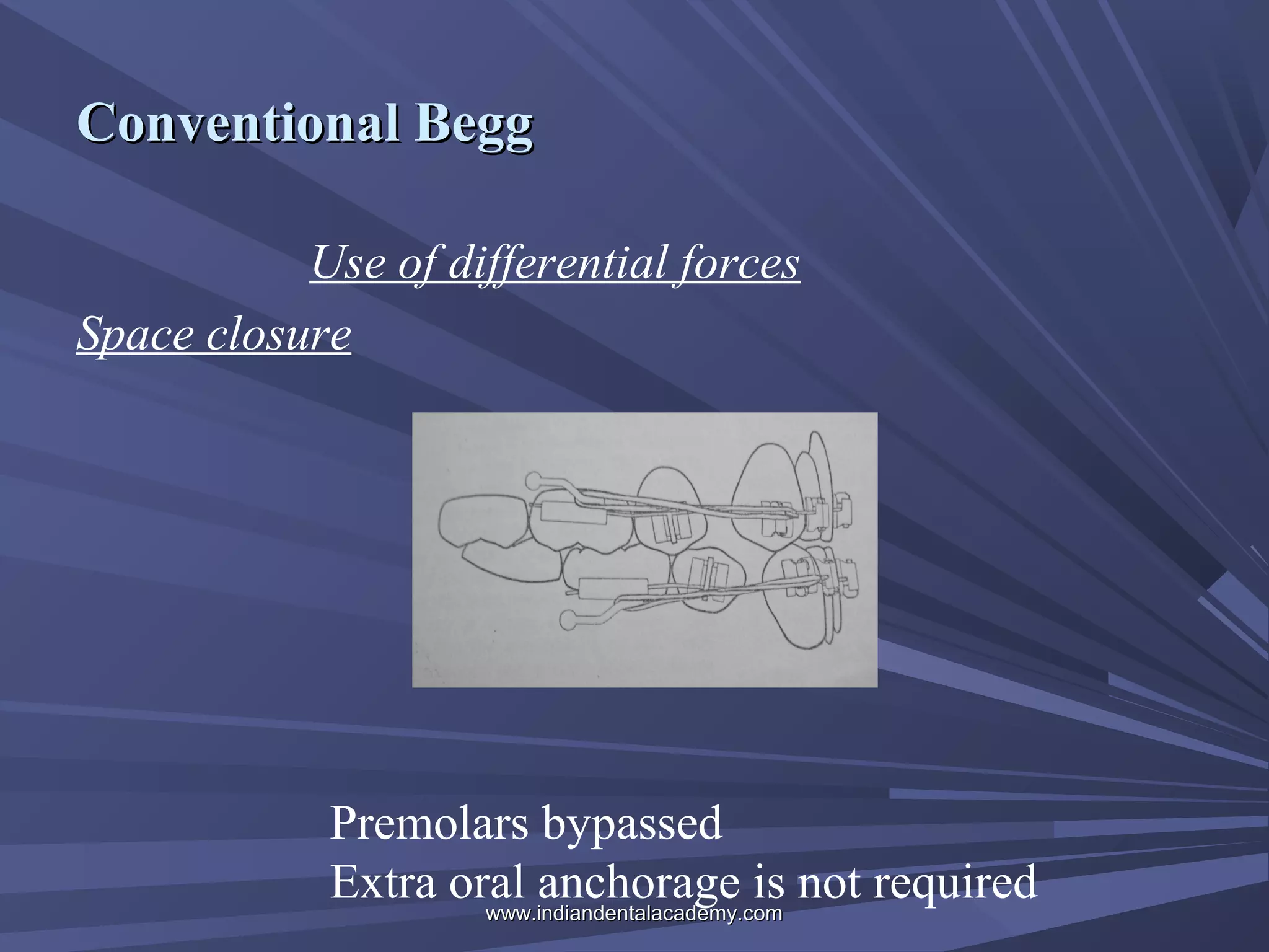 Conventional Begg
Use of differential forces
Space closure

Premolars bypassed
Extra oral anchorage is not required
www.indiandentalacademy.com

 