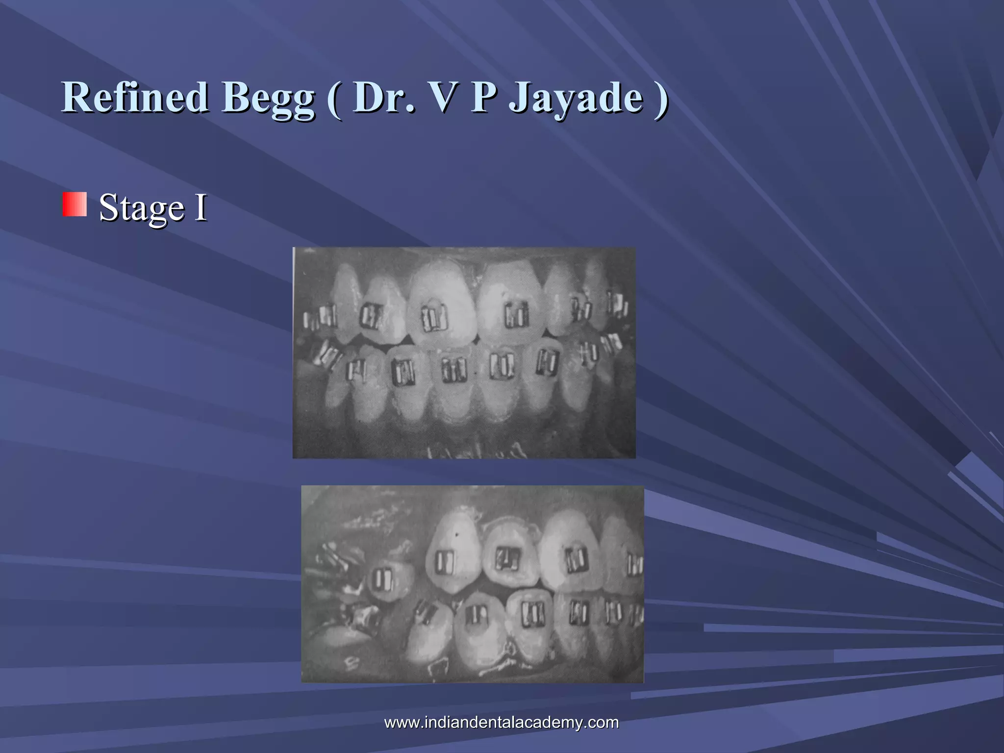 Refined Begg ( Dr. V P Jayade )
Stage I

www.indiandentalacademy.com

 