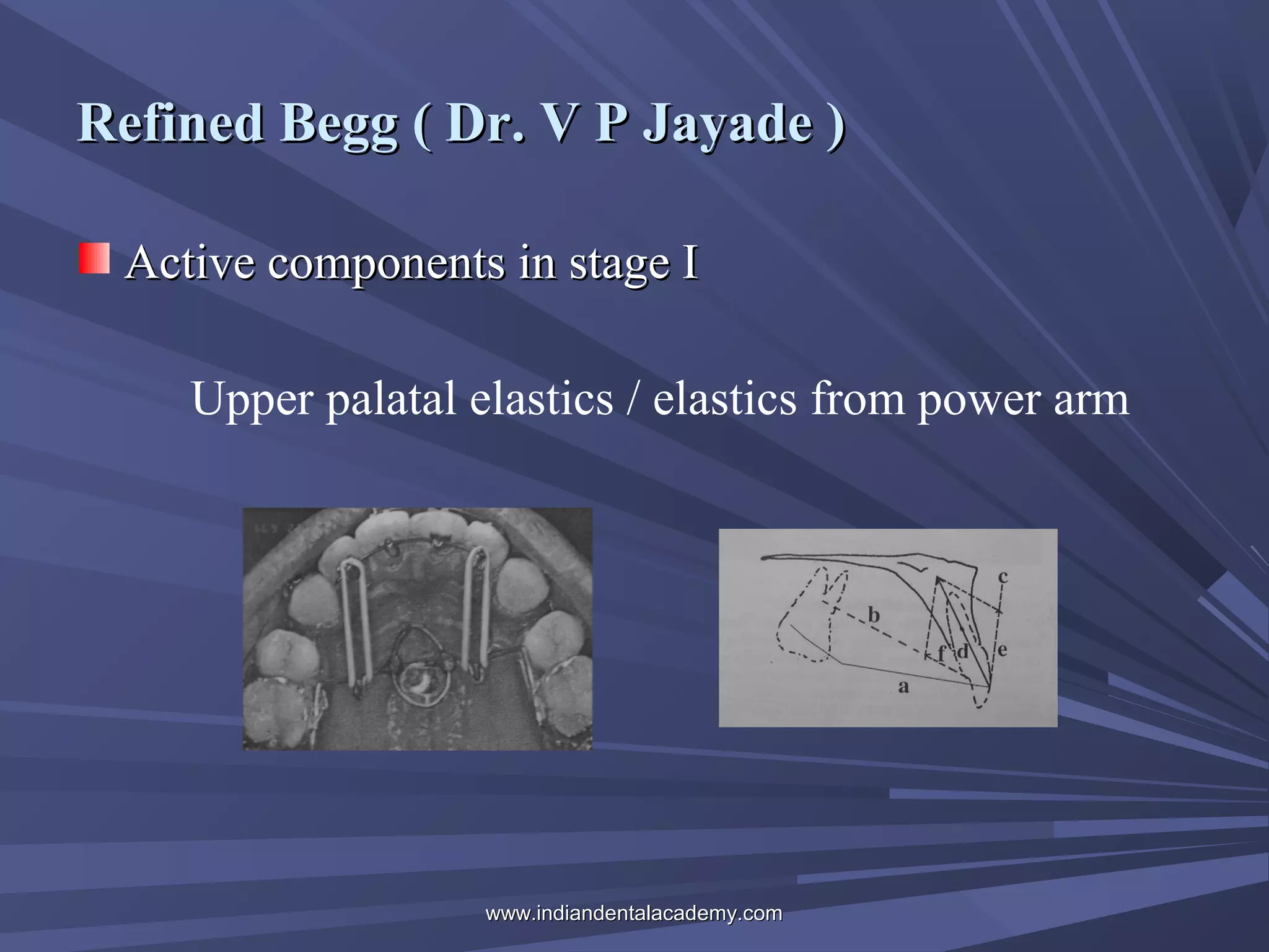 Refined Begg ( Dr. V P Jayade )
Active components in stage I
Upper palatal elastics / elastics from power arm

www.indiandentalacademy.com

 