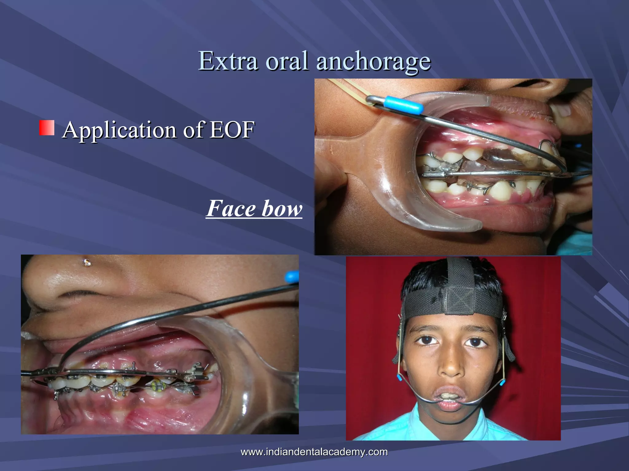 Extra oral anchorage
Application of EOF
Face bow

www.indiandentalacademy.com

 