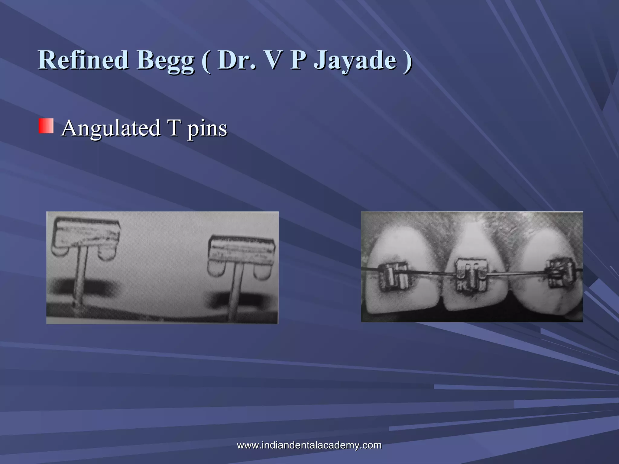 Refined Begg ( Dr. V P Jayade )
Angulated T pins

www.indiandentalacademy.com

 