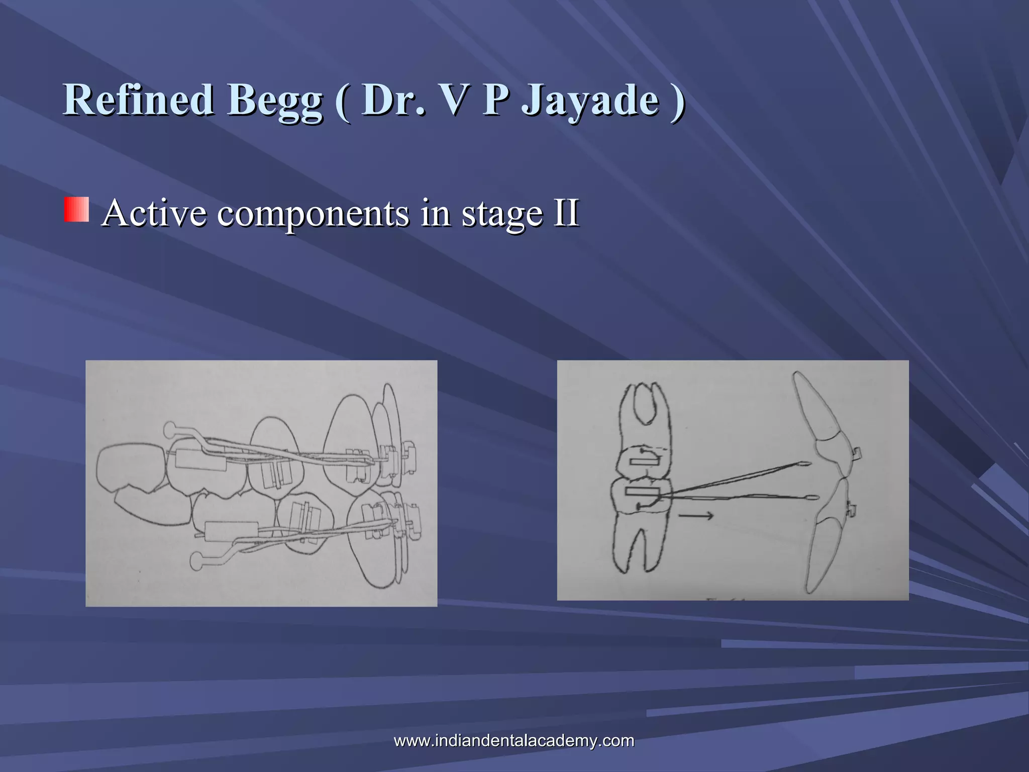 Refined Begg ( Dr. V P Jayade )
Active components in stage II

www.indiandentalacademy.com

 