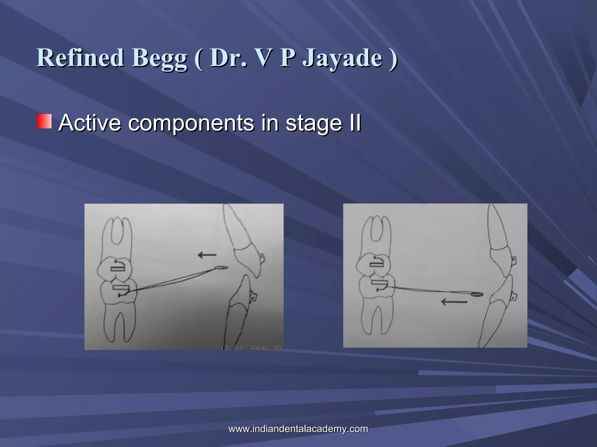 Refined Begg ( Dr. V P Jayade )
Active components in stage II

www.indiandentalacademy.com

 