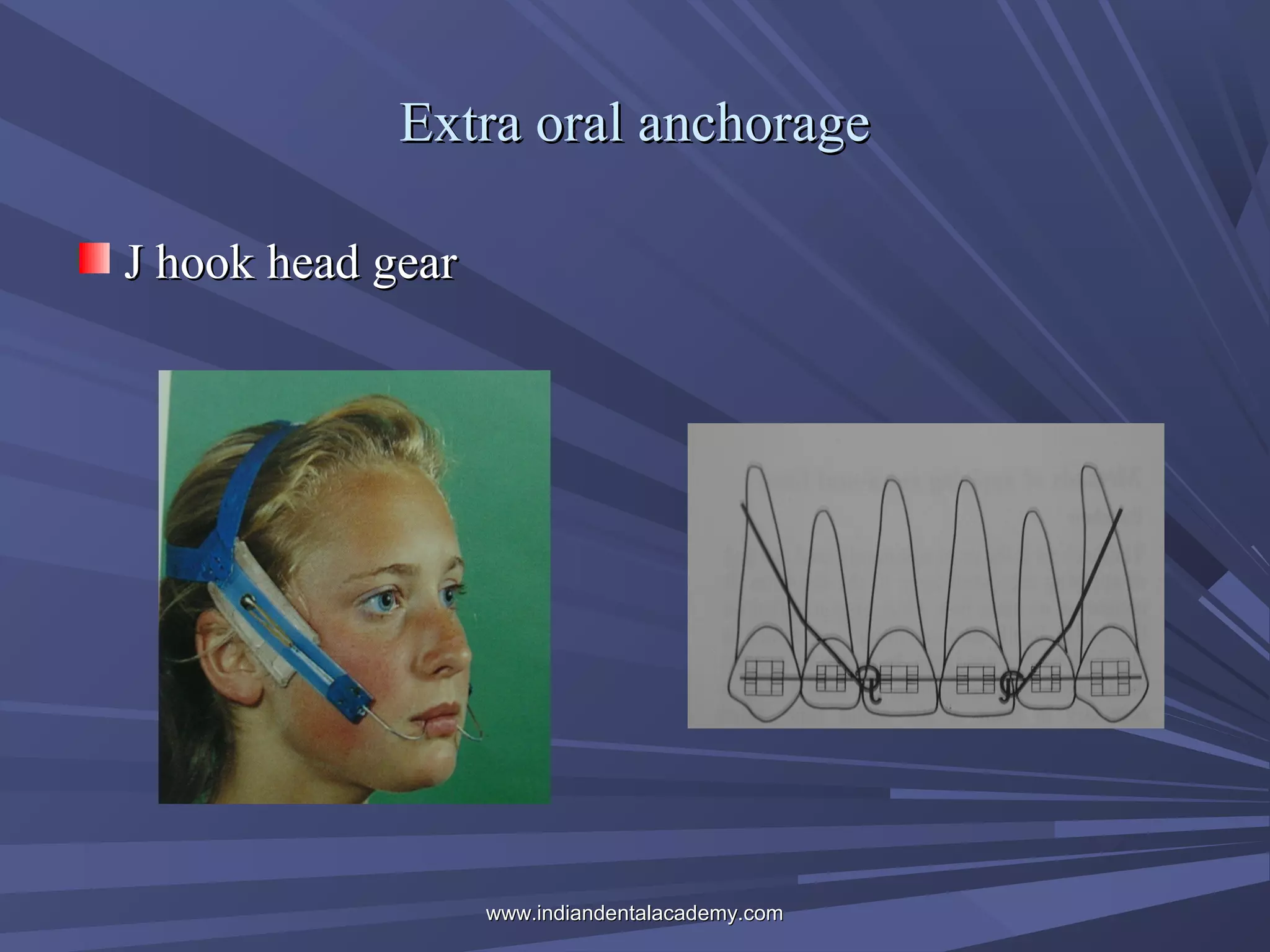 Extra oral anchorage
J hook head gear

www.indiandentalacademy.com

 
