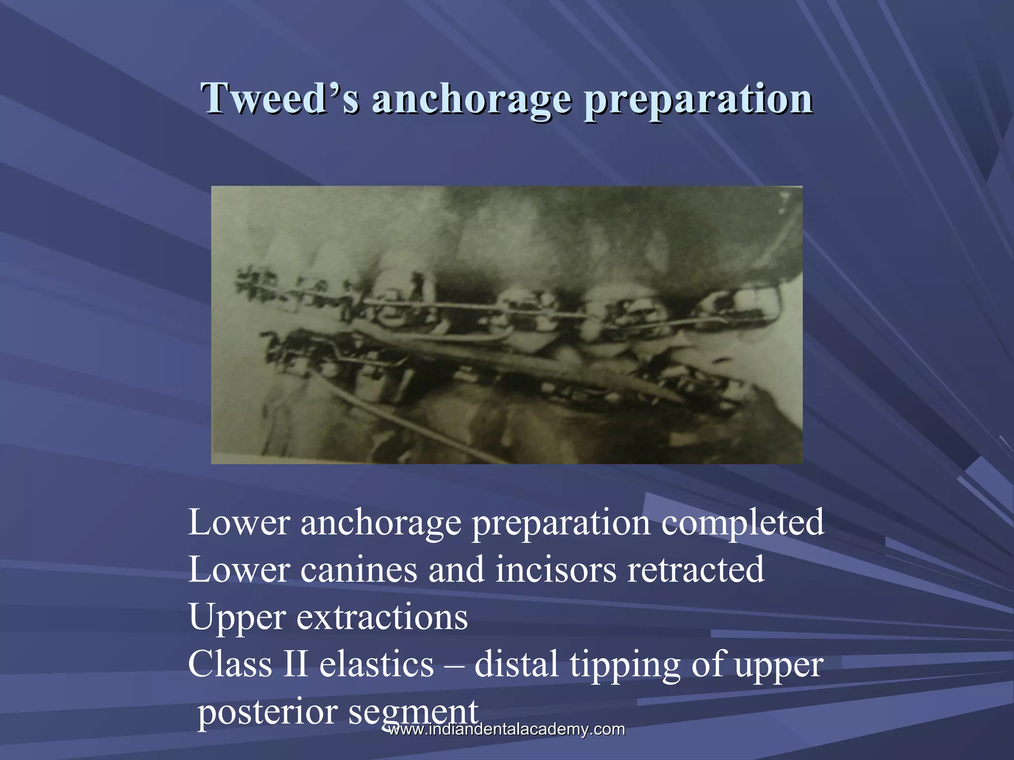 Tweed’s anchorage preparation

Lower anchorage preparation completed
Lower canines and incisors retracted
Upper extractions
Class II elastics – distal tipping of upper
posterior segment
www.indiandentalacademy.com

 