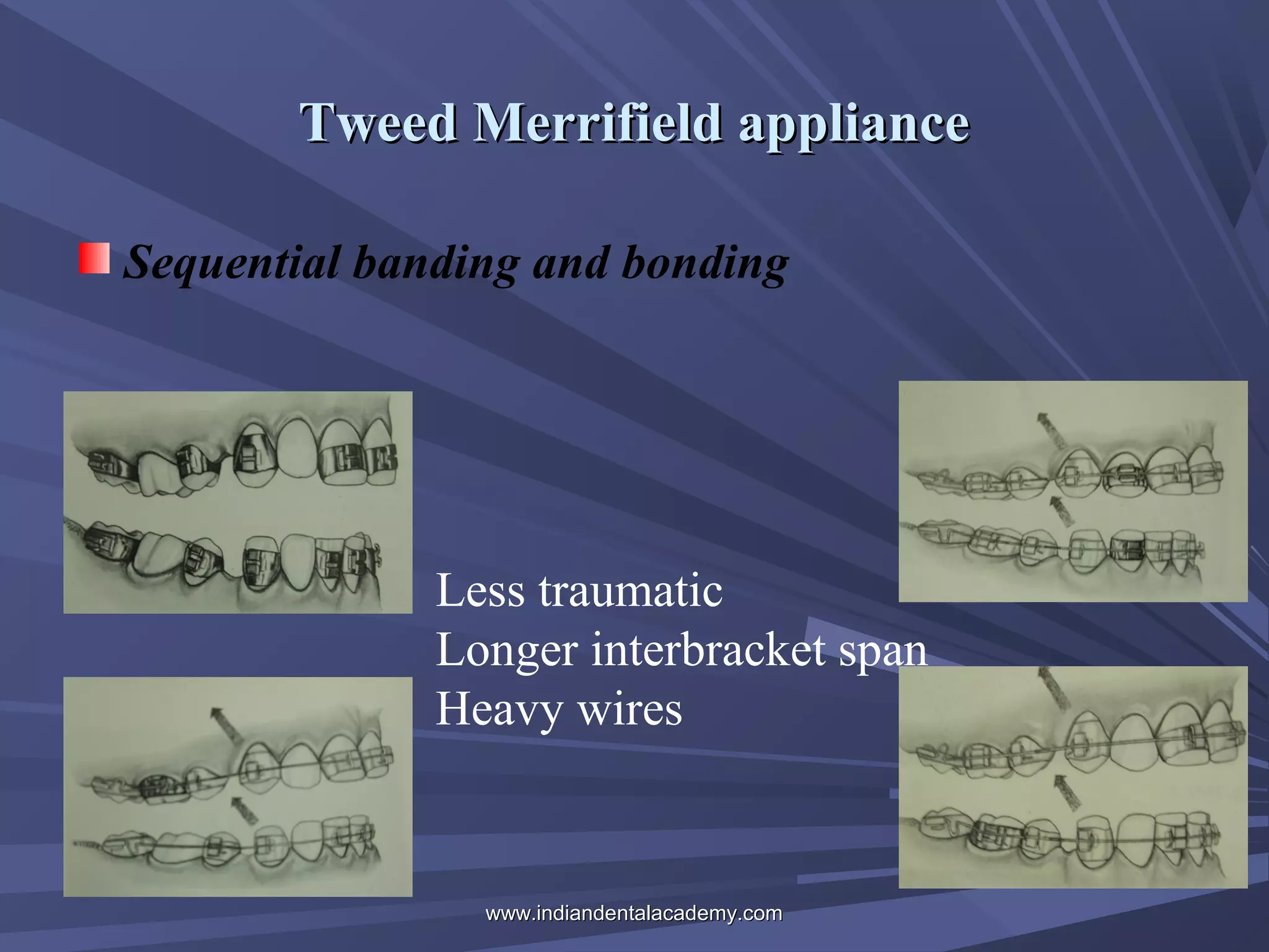 Tweed Merrifield appliance
Sequential banding and bonding

Less traumatic
Longer interbracket span
Heavy wires

www.indiandentalacademy.com

 
