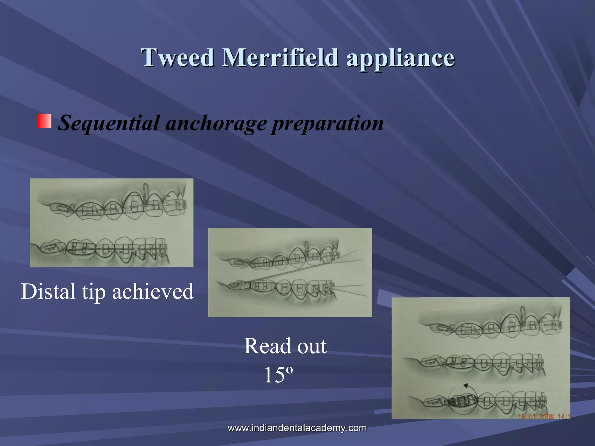 Tweed Merrifield appliance
Sequential anchorage preparation

Distal tip achieved
Read out
15º
www.indiandentalacademy.com

 